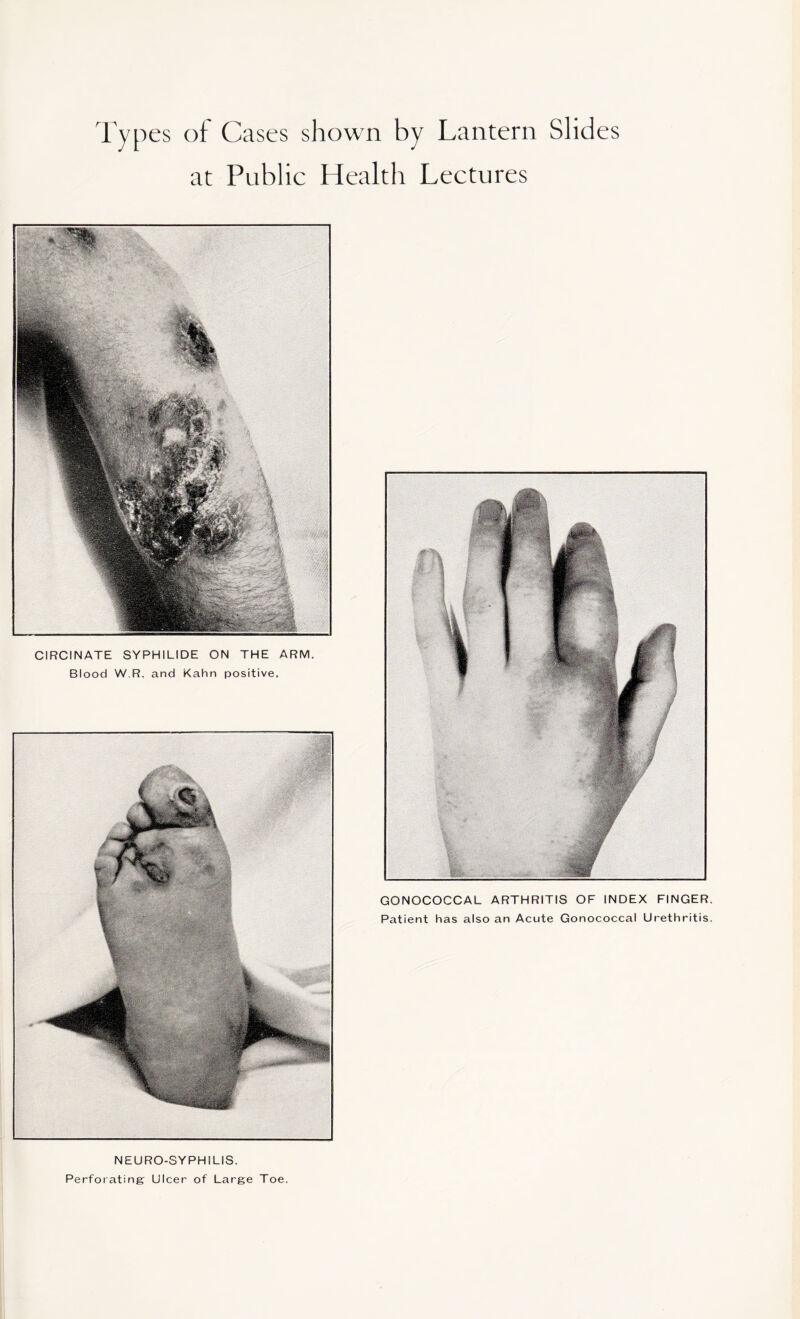 Types of Cases shown by Lantern Slides at Public Health Lectures CIRCINATE SYPHILIDE ON THE ARM. Blood W.R. and Kahn positive. GONOCOCCAL ARTHRITIS OF INDEX FINGER Patient has also an Acute Gonococcal Urethritis NEURO-SYPHILIS. Perforating Ulcer of Large Toe.