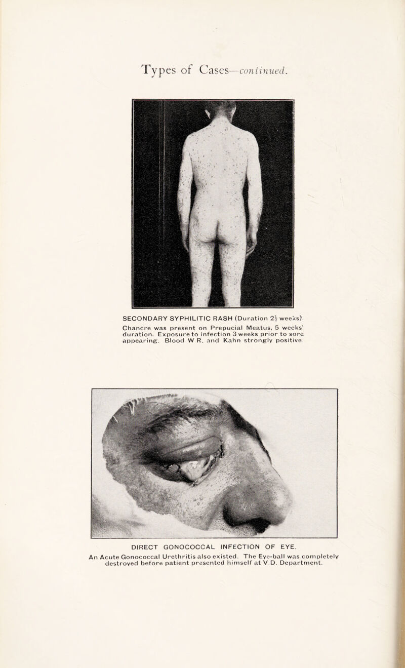 Typ es of Cases —continued. SECONDARY SYPHILITIC RASH (Duration 2\ weeks). Chancre was present on Prepucial Meatus, 5 weeks’ duration. Exposure to infection 3 weeks prior to sore appearing. Blood W R. and Kahn strongly positive. DIRECT GONOCOCCAL INFECTION OF EYE. An Acute Gonococcal Urethritis also existed. The Eye-ball was completely destroyed before patient presented himself at V D. Department.