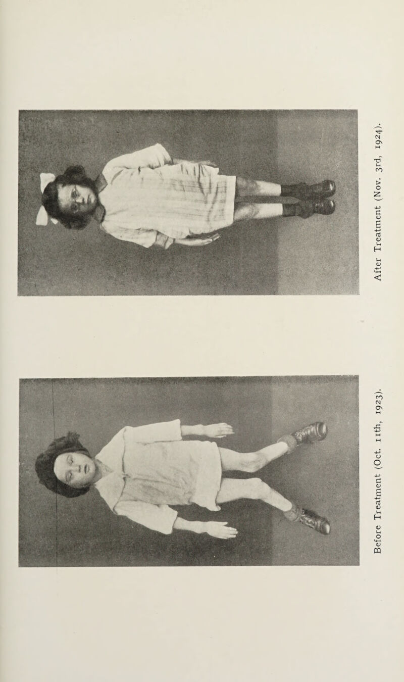 Before Treatment (Oct. nth, 1923). After Treatment (Nov. 3rd, 1924).