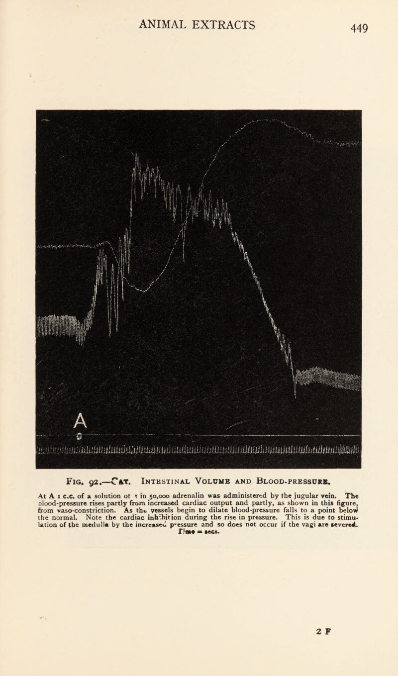 Fig, 92.—Cat. Intestinal Volume and Blood-pressure, At A I c.c. of a solution ot t in 50,000 adrenalin was administered by the jugular vein. The olood-pressure rises partly from increased cardiac output and partly, as shown in this figure, from vaso-constriction. As th«, vessels begin to dilate blood-pressure falls to a point below the normal. Note the cardiac inhibition during the rise in pressure. This is due to stimu- lation of the medulla by the increased p-essure and so does not occur if the vagi are severed. rioae >■ secs.