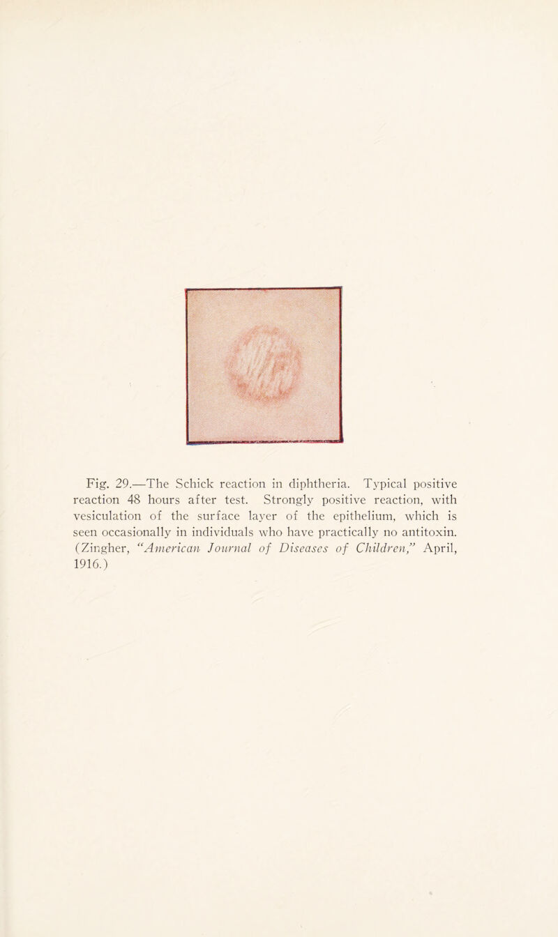 Fig. 29.—The Schick reaction in diphtheria. Typical positive reaction 48 hours after test. Strongly positive reaction, with vesiculation of the surface layer of the epithelium, which is seen occasionally in individuals who have practically no antitoxin. (Zingher, “American Journal of Diseases of Children” April, 1916.)