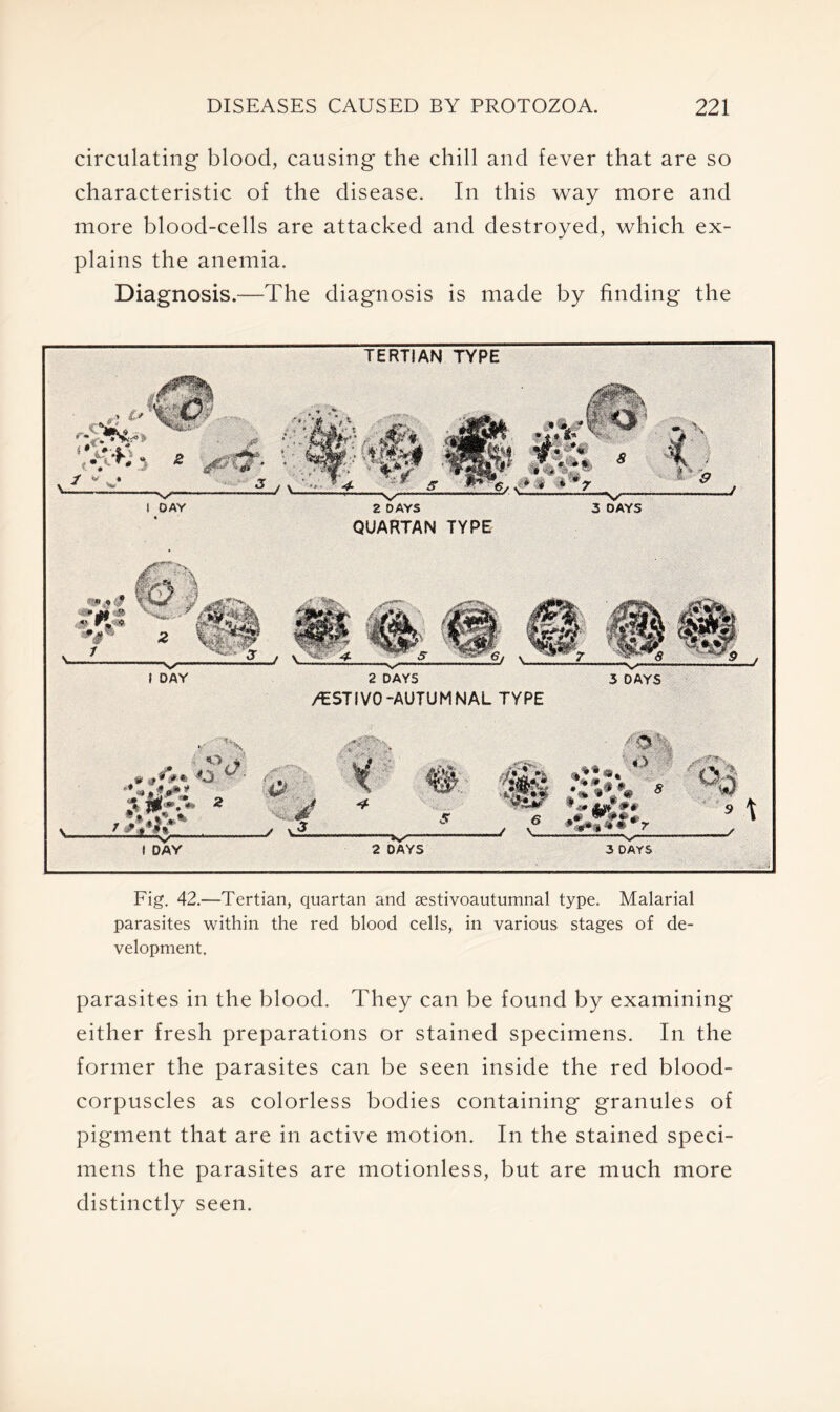 circulating blood, causing the chill and fever that are so characteristic of the disease. In this way more and more blood-cells are attacked and destroyed, which ex- plains the anemia. Diagnosis.—The diagnosis is made by finding the Fig. 42.—Tertian, quartan and sestivoautumnal type. Malarial parasites within the red blood cells, in various stages of de- velopment. parasites in the blood. They can be found by examining either fresh preparations or stained specimens. In the former the parasites can be seen inside the red blood- corpuscles as colorless bodies containing granules of pigment that are in active motion. In the stained speci- mens the parasites are motionless, but are much more distinctly seen.