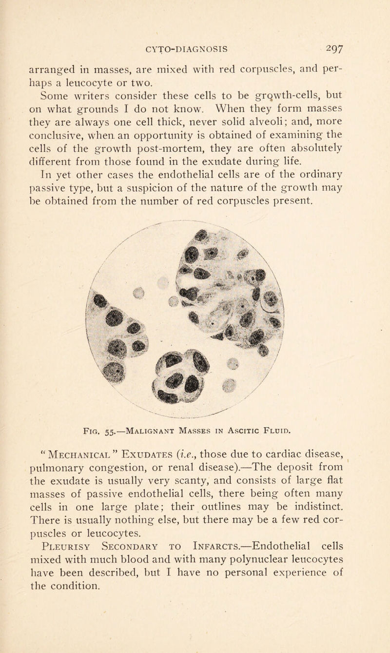 arranged in masses, are mixed with red corpuscles, and per- haps a leucocyte or two. Some writers consider these cells to be growth-cells, but on what grounds I do not know. When they form masses they are always one cell thick, never solid alveoli; and, more conclusive, when, an opportunity is obtained of examining the cells of the growth post-mortem, they are often absolutely different from those found in the exudate during life. In yet other cases the endothelial cells are of the ordinary passive type, but a suspicion of the nature of the growth may be obtained from the number of red corpuscles present. Fig. 55.—Malignant Masses in Ascitic Fluid. “ Mechanical ” Exudates (i.e., those due to cardiac disease, pulmonary congestion, or renal disease).—The deposit from the exudate is usually very scanty, and consists of large flat masses of passive endothelial cells, there being often many cells in one large plate; their outlines may be indistinct. There is usually nothing else, but there may be a few red cor- puscles or leucocytes. Pleurisy Secondary to Infarcts.—Endothelial cells mixed with much blood and with many polynuclear leucocytes have been described, but I have no personal experience of the condition.