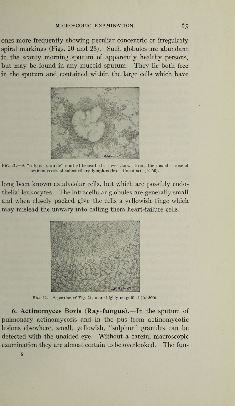 ones more frequently showing peculiar concentric or irregularly spiral markings (Figs. 20 and 28). Such globules are abundant in the scanty morning sputum of apparently healthy persons, but may be found in any mucoid sputum. They lie both free in the sputum and contained within the large cells which have Fig. 21.—A “sulphur granule” crushed beneath the cover-glass. From the pus of a case of actinomycosis of submaxillary lymph-nodes. Unstained (X 60). long been known as alveolar cells, but which are possibly endo- thelial leukocytes. The intracellular globules are generally small and when closely packed give the cells a yellowish tinge which may mislead the unwary into calling them heart-failure cells. Fig. 22.—A portion of Fig. 21, more highly magnified (X 300). 6. Actinomyces Bovis (Ray=fungus).—In the sputum of pulmonary actinomycosis and in the pus from actinomycotic lesions elsewhere, small, yellowish, “sulphur” granules can be detected with the unaided eye. Without a careful macroscopic examination they are almost certain to be overlooked. The fun- S