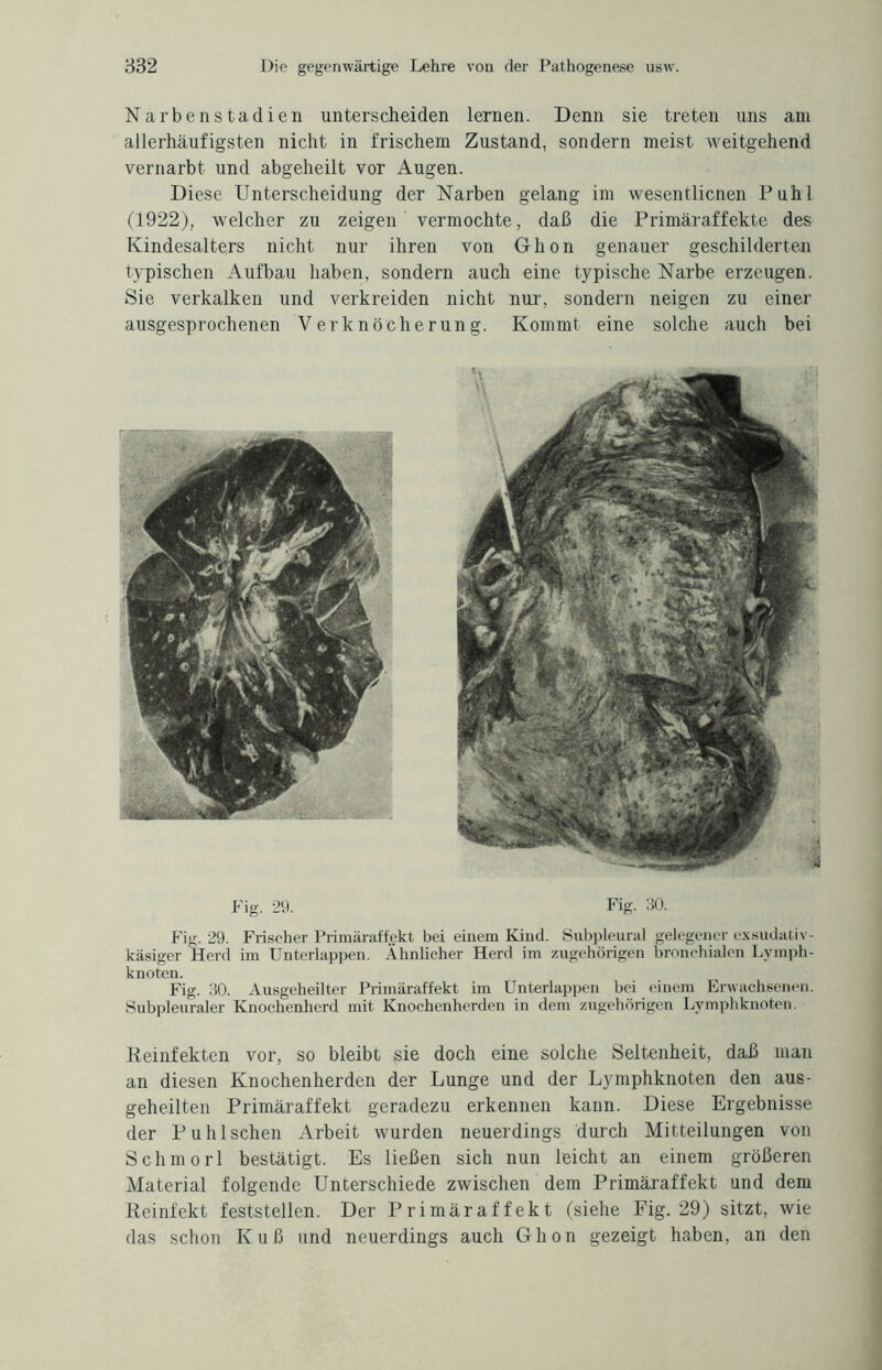 Narbenstadien unterscheiden lernen. Denn sie treten uns am allerhäufigsten nicht in frischem Zustand, sondern meist weitgehend vernarbt und abgeheilt vor Augen. Diese Unterscheidung der Narben gelang im wesentlichen Puhl (1922), welcher zu zeigen vermochte, daß die Primäraffekte des Kindesalters nicht nur ihren von Ghon genauer geschilderten typischen Aufbau haben, sondern auch eine typische Narbe erzeugen. Sie verkalken und verkreiden nicht nur, sondern neigen zu einer ausgesprochenen Verknöcherung. Kommt eine solche auch bei Fig. 29. Fig. 30. Fig. 29. Frischer Primäraffekt bei einem Kind. Subpleural gelegener exsudativ- käsiger Herd im Unterlappen. Ähnlicher Herd im zugehörigen bronchialen Lymph¬ knoten. Fig. 30. Ausgeheilter Primäraffekt im Unterlappen bei einem Erwachsenen. Subpleuraler Knochenherd mit Knochenherden in dem zugehörigen Lymphknoten. Reinfekten vor, so bleibt sie doch eine solche Seltenheit, daß man an diesen Knochenherden der Lunge und der Lymphknoten den aus¬ geheilten Primäraffekt geradezu erkennen kann. Diese Ergebnisse der Puhl sehen Arbeit wurden neuerdings durch Mitteilungen von Schmorl bestätigt. Es ließen sich nun leicht an einem größeren Material folgende Unterschiede zwischen dem Primäraffekt und dem Reinfekt feststellen. Der Primäraffekt (siehe Fig. 29) sitzt, wie das schon Kuß und neuerdings auch Ghon gezeigt haben, an den