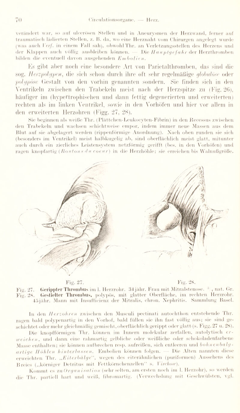 verändert war. so auf uleerösen Stellen und in Aneurysmen der Herzwand, ferner auf traumatisch lädierten Stellen, z. B. da. wo eine Herznaht vom Chirurgen angelegt wurde (was auch I erf. in einem Fall sah), obwohlThr. an Verletzungsstellen des Herzens und der Klappen auch völlig aushleihen können. Die //auplijefahr der Herzthromben bilden die eventuell davon ausgehenden l'Jinbolicn. 17s gild aber noch eine besondere Art von Parietalthroniben, das sind die sog. lleicjwlnpru, die sielt schon durch ihre oft sehr regelmäßige globuliise oder poljl/iiisr (iestalt von den vorhin genannten sondern. Sie finden sielt in den Ventrikeln zwischen den Trabekeln meist nach der Herzspitze zu (Fig. 26), häufiger im (hypertrophischen und dann fettig degenerierten und erweiterten) rechten als im linken Ventrikel, sowie in den Vorhöfen und hier vor allem in den erweiterten Herzohren (Figg. 27. 28). Sie beginnen als weiIle Thr. ( Plättchen-Leukoeyten-Fibrin) in den Keccssus zwischen den Trabekeln und wachsen schiebt weise empor, indem immer neue Massen aus dem Blut auf sie abgelagert werden (rippenförmige Anordnung). Nach oben runden sie sieh (besonders im Ventrikel) meist halbkugelig ab, sind oberflächlich meist glatt, mitunter auch durch ein zierliches Leistensystem netzförmig gerifft (bes. in den Vorhöfen) und ragen knopfartig (Bouton * /InCoeur) in die Herzhöhle: sie erreichen bis Walnußgroße. c Fig. Fig. 27. Gerippter Thrombus im 1. Herzrohr. 34 jälir. Frau mit Mitralstenose. , nat. Gr. 28. Gestielter Thrombus, polypös, mit glatter Oberfläche, im rechten Herzrohr. 4ö jälir. Mann mit Insuffieienz der Mitralis, chron. Nephritis. Sammlung Basel. In den II erzohren zwischen den Musculi pectinati autoehthon entstehende Thr. ragen bald polypenartig in den Vorhof, bald füllen sie ihn fast völlig aus; sie sind ge¬ schichtet oder mehr gleichmäßig gemischt, oberflächlich gerippt oder glatt (s. Figg. 27 u. 28). Die knopfförmigen Thr. können im Innern molekular zerfallen, autolytisch er¬ weichen, und dann eine rahmartig gelbliche oder weißliche oder schokoladenfarbene Masse enthalten; sie können auf brechen resp. aufreißen, sieh entleeren und bohnenbahj - arlif/e Höhlen hi Hierin ssen. Fmbolien können folgen. Die Alten nannten diese erweichten Thr. „Eilerbiilt/c, wegen des eitel-ähnlichen (puriformen) Aussehens des Breies („körniger Detritus mit Fettkörnchenzcllen* s. I irehow). Kommt es r.nOri/an i«nIion (sehr selten, am ersten noch im I. Herzohr), so werden die Thr. partiell hart und weiß, fibromartig. (Verwechslung mit Geschwülsten, vgl.