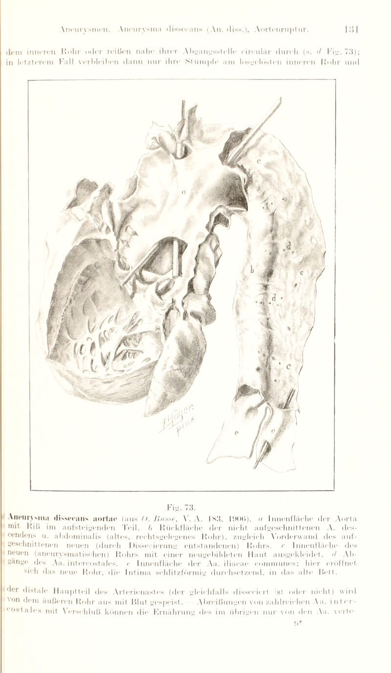 Xneurvsmen. Aneurysma dissecans An, diss.), Aortenruptur. l:;i dem inneren Ruhr oder reißen nahe ihrer Ahfaufsstclle circular durch (s. <1 Ki<j. 7.‘i) in letzterem Kall verbleiben dann nur ihre Stümpfe am losaeinsten inneren Ruhr um Kia. 7.'i. Aneurysma dissecans aortae (aus (). Hasse, V. A. |Nß, 11M)(>). u Innenfläche der Aorta mil Riß im auf steifenden Teil, h Riiekf hielte der nicht aufyescluüttenen A. des- cendens u. abdominalis (altes, reehtsfelefenes Rohr), /aiLdeieh Vorderwand des aut- fesehnit 1 enen neuen (durch I Jissceierinif ejitstandenen) Rohrs, r Innenfläche des neuen (aneurysmatischen) Rohrs mit einer neiifobildetcn Haut ausfckleidet, il Ab- aan<;e des Aa. intercostales. e Innenfläche der Aa. iliacae eommunes; hier eröffnet sich das neue Rohr, die Intima sehlit/.förmiu durchsetzend, in das alte Heit. dei distale Hauptteil des Arterienast es (der gleichfalls disseeiert sl oder nicht) wird '• on dem äußeren Rohr aus mit Blut fespeist. Abreißiuifcn von zahlreichen Aa. inter- * ostales mit \ ersehluß können die Krnahrunu des im iibrifen nur von den Aa. verte