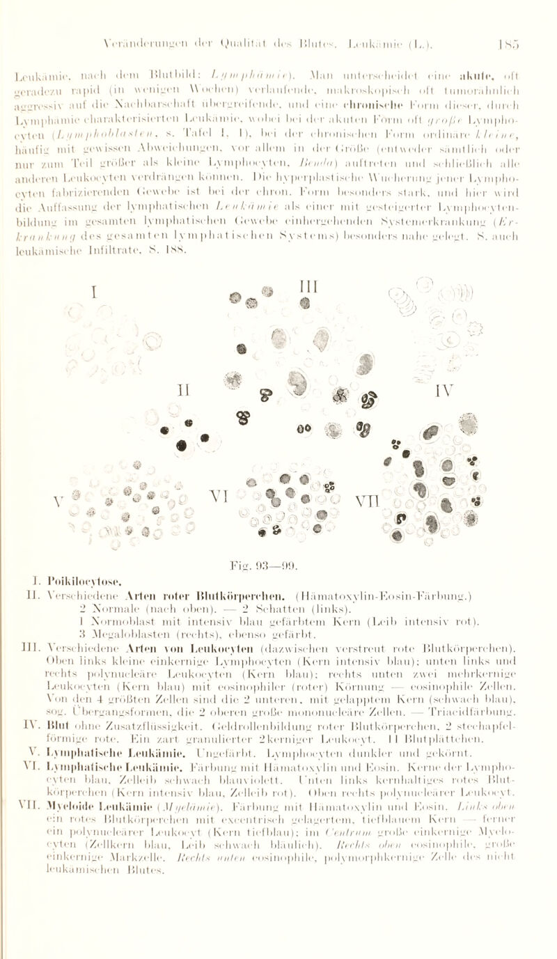 Leukämie, nach dem Blutbild: /. // in /i/iii in i <). Mau unterscheidet eine akute, ult geradezu rapid (in wenigen Wochen) verlautende, makroskopisch oft tumorähnlich aggressiv auf die Nachbarschaft überereilende, und eine chronische Form dieser, durch Lvmphamie charakterisierten Leukämie, wobei bei der akuten Form oft i/ro/.li Lvmpho- evten ( L n in /> li obl n ' le n , s. latel !. I), bei der chronischen Form ordinäre kleine, häufig mit gewissen Abweichungen, vor allem in der (Jrolle (entweder sämtlich oder nur zum Feil größer als kleine Lymphoeyten, lleniln) aultreten und schließlich alle anderen Leukoeyten verdrängen können. Die hypcrplnstische Wucherung jener Lympho- evten fabrizierenden (lewebe ist bei der ehron. form besonders stark, und hier wird die Auffassung der lymphatischen Lenkiiniii als einer mit gesteigerter Lvmphoeyten- bildung im gesamten lymphatischen (lewebe einhergehenden S\stenierkrankung (Er kr« ii I: ii tu/ des gesamten lymphatischen Systems) besonders nahe gelegt. S. auch leukämische Infiltrate. S. Iss. • r 11 & _ Hl <8 ^ & * i » Q VI öö FA £3 IV 0 0 * VT1 , -i» $ : * Fig. 93—99. I. Poikilocytoso. 11. Verschiedene Allen roter Blutkörperchen. (Hämatoxylin-Eosin-Färbung.) 2 Normale (nach oben). — 2 Schatten (links). I Norm oblast mit intensiv blau gefärbtem Kern (Leib intensiv rot). 3 Megaloblasten (rechts), ebenso gefärbt. 111. Verschiedene Allen von Leukoeyten (dazwischen verstreut rote Blutkörperchen). Oben links kleine einkernige Lymphoeyten (Kern intensiv blau); unten links und rechts polvnucleäre Leukoeyten (Kern blau): rechts unten zwei mehrkernige Leukoeyten (Kein blau) mit eosinophiler (roter) Körnung — eosinophile Zellen. Von den 4 größten Zellen sind die 2 unteren, mit gelapptem Kern (schwach blau), sog. Ubergangsformen, die 2 oberen große mononuclcärc Zellen. — Triaeidfarbung. 1\. Blut ohne Zusatzflüssigkeit. (leldrollenbildung roter Blutkörperchen. 2 Stechapfel förmige rote. Ein zart granulierter 2kerniger Leukocyt. II Blutplättchen. Lymphatische Leukämie. Ungefärbt. Lymphocvten dunkler und gekörnt. NI. Lymphatische Leukämie. Färbung mit Hämatoxylin und Eosin. Kerne der Lympho- cyten blau, Zclleib schwach blauviolett. Unten links kernhaltiges rotes Blut¬ körperchen (Kern intensiv blau, Zclleib rot). (Iben rechts polvnucleärer Leukocyt. VII- M\ eloide beul iäinie (M i/eUiinie). Färbung mit Ilämatowlin und Eosin. Links oben e:n rotes Blutkörperchen mit excentrisch gelagertem, tiefblauem Kern ferner ein polvnucleärer Leukocvt (Kern tiefblau); im ('ent,nun große einkernige Myclo- evten (Zellkern blau, Leib schwach bläulich). Hechts oben eosinophile, große einkernige .Mark/.elle. Hechts unten eosinophile, polymorphkernige Zelle des nicht leukämischen Blutes.
