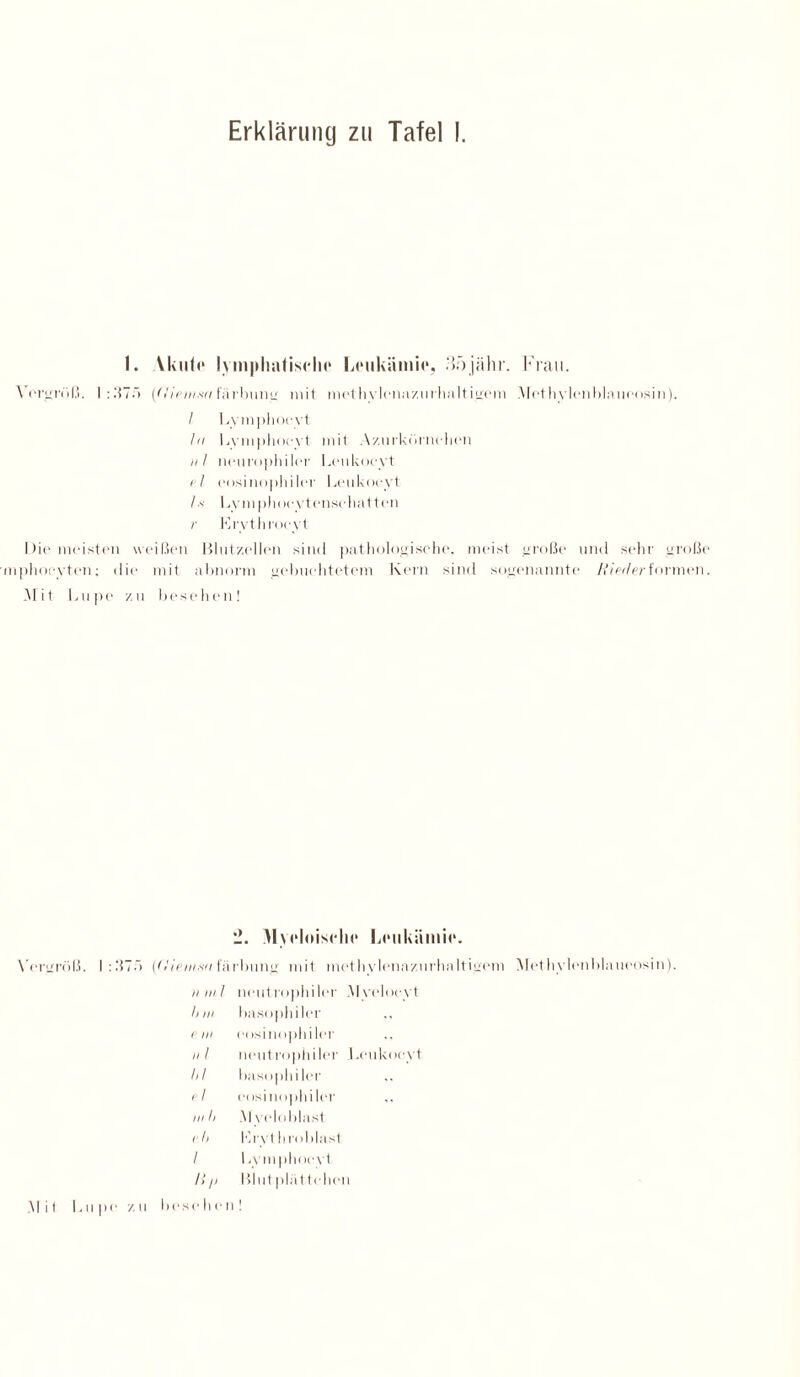 Erklärung zu Tafel I. 1. Vkule lymphatische Leukämie, 'iöjähr. Frau. Yorgrüß. 1:375 (fliemxa fiirbung mit methylenazurhaltigem Methylenblauoosin). / Lymphocyt In Lymphocyt mit Azurkörnehen i/l neurophiler Leukoeyt el c'osino|)hiIer Leukoeyt Ix Lymphoevtensehatt en r Krythrooyt Die meisten weißen Blutzellen sind pathologische, meist große und sehr große mphocyten; die mit abnorm gebuchtetem Kern sind sogenannte /fbWerformen. Mit Lupe zu besehen! 2. Myeloische Leukämie. Vergröß. 1:375 (Uiemxa färbung mit methylenazurhaltigem Methylenblaueosin). II III 1 neutrophiler Myeloeyt ll III basophiler e in eosinophiler ii 1 neut roph i ler 1 .eukoeyt 1,1 basophiler el eosinophiler in Ii M veloblast r Ii l’lrythro bläst 1 1 ,ymphoe vt l>l> Blut pliitteilen leseben 1