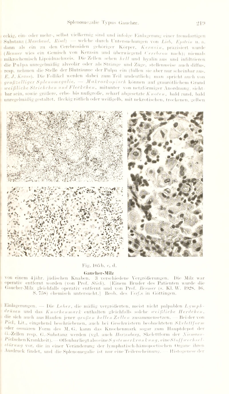 Splenomegalie Typus (laudier. •21!' eckig. ein- oder mehr-, seihst vielkcrnig sind und infolge F,inlagrrung einer Iremdarligcn Substanz (Mnrchciml, Hisel) welche durch 1 ntersiichungen von Lieh, Epstein u. a. dann als ein zu den ( erebrosiden gehöriger Körper. A < rnsin, präzisiert w urde {Beutner w ies ein (lemiseh von Kerasin und überwiegend ( * rihron nach); niemals mikrochemisch Lipoidnaehvveis. Die/eilen sehen hell und hyalin aus und infiltrieren die Pulpa unregelmäßig alveolär oder als Stränge und Züge, stellenweise aueli diffus, resp. nehmen die Stelle der Bluträume der Pulpa ein (liillen sie aber nur scheinbar aus. E. J. Sinns), Die lollikel werden dabei zum l'cil undiuit lieh; mau spricht auch von großzelliger Splenomegalie. — Makroskopisch können auf graurötlieliein < irund weißliche Strichelten uml h le.ckc.hen, mitunter von netzförmiger Anordnung. sieht bar sein, sowie größere. erbs- bis nußgroße, scharf abgesetzte Knoten, bald rund, bald unregelmäßig gestaltet, fleckig rötlich oder weißgelb, mit nekrot isehen. t roekenen. selben Fig. 105 b. c. d. Gaucher-Alilz von einem 4jähr. jüdischen Knaben, ß verschiedene \’crgrößerungen. Die .Milz war operativ entfernt worden (von Prof. Stich). [Kinetn Bruder des Patienten wurde die Gaucher-Milz gleichfalls operativ entfernt und von Prof, Beutner (s. Kl. \\ . lihJts. 10. 8. TfiN) chemisch untersucht.] Beob. des 1 '<r/'.s in Göttingen. Kinlagcrungen. — Die Leiter, die mäßig vergrößerten, meist nicht palpablen l.gtnph (Irüseii und das K uoeItenmar I, enthalten gleichfalls solche weißliche llerdchen, die sich auch aus Haufen jener großen hellen/eilen zu sammelt setzen. Bei der von kick, Lit., eingehend beschriebenen, auch bei Geschwistern beobachteten Skelelljortn oder ossuären Form des AI. G. kann das Knochenmark sogar zum llauptdepot der G.-Ze|| en resp. (1.-Substanz werden (vgl. auch Herzenherg, Skelettform der S tenttitin 1 letschen K ran kheit). ()f teilbar I i(“gt a Iso eine S gs I e in e r l r a n k n n g, ei ne <S' t nJJ in c h sei Störung vor. die in einer Veränderung der Ivmpliatiseh-hämopoct isehen Organe ihren Ausdruck findet, und die Splenomegalie ist nur eine Teilerseheinung. II istogenese der