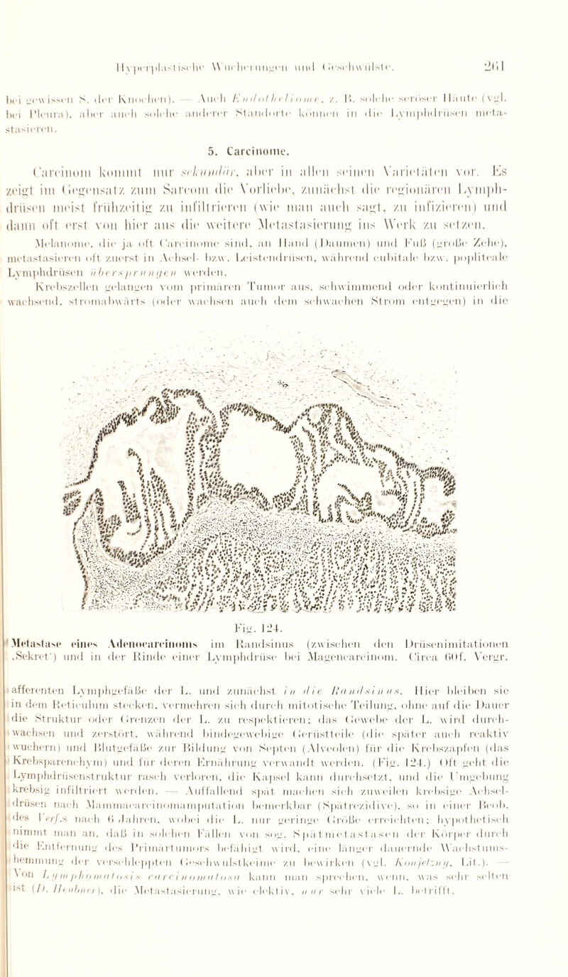 l)t'i gewissen S. ilrr Knochen). Auch En tlol hei t ome, z. I). solche seröser Haute (vgl. bei Pleura), aber auch solche anderer Standorte können in die Lymphdrüsen meta¬ stasieren. 5. Carcinome. (’arcinoni kommt nur sckiuidHr. aber in allen seinen Varietäten vor. Es zeigt im (legensatz zum Sareom die Vorliebe, zunächst die regionären Lyni])h- driisen meist frühzeitig zu infiltrieren (wie man auch sagt, zu infizieren) und dann oft erst von hier aus die weitere Metastasierung ins Werk zu setzen. .Melanome, die ja oft Carcinome sind, an Hand (Daumen) und Fuß (große Zehe), metastasieren oft zuerst in Achsel- bzw. Leistendrüsen, während cubitalc bzw. poplitealc Lvmphdriisen ii ber*pru n gen werden. Ki 'ebszellen gelangen vom primären Tumor aus, schwimmend oder kontinuierlich wachsend, stromabwärts (oder wachsen auch dem schwachen Strom entgegen) in die |pf r Metastase eines Ailenneareiiioms im Randsinus (zwischen den Drüsenimitationen Sekret') und in der Rinde einer Lvmphdriise bei Magencareinom. Circa (i()f. Vergr. afferenten Lymphgefäße der L. und zunächst in die Ranihfiu us. Hier bleiben sie in dem Rcticulum stecken, vermehren sich durch mitotische Teilung, ohne auf die Dauer die Struktur oder Grenzen der L. zu respektieren; das Gewebe der L. wird durch¬ wachsen und zerstört, während bindegewebige Gerüstteile (die später auch reaktiv wuchern) und Blutgefäße zur Bildung von Kopten (Alveolen) für die Krebszapfen (das Krebsparenehym) und für deren Ernährung verwandt werden. (Fig. 124.) Oft geht die Lymphdrüsenstruktur rasch verloren, die Kapsel kann durchsetzt, und die Hingebung krebsig infiltriert werden. Auffallend spät machen sieh zuweilen krebsige Aehsel- driisen nach Alammaeareinomamputation bemerkbar (Spät rezidi ve), so in einer Beob. des 1 p/-/.s nach (> Jahren, wobei die L. nur geringe Größe erreichten; hypothetisch nimmt man an, daß in solchen Fällen von sog. S p;i t m e t a st a sen der Körper durch die Entfernung des Primärtumors befähigt wird, eine länger dauernde Waehstums- hemmung der verschleppten Geschwulst keime zu bewirken (vgl. I\ mi jelzn//, Li t.). ' on L g in p ho in it I o.s in riirrinoiiiiil usa kann man sprechen, wenn, was sehr selten i'i (/>. Ileiil/nei), die Metastasierung, wie clektiv, nur sehr viele L. betrifft.