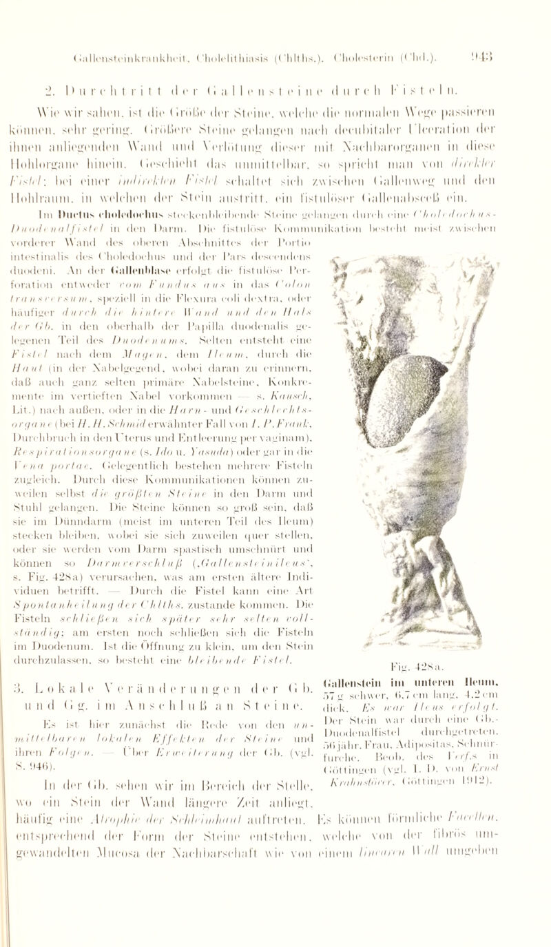 2. I) u r c h 1 r i t t (I t’ r (I a I I e n s t o i n e il ii r e li K ist (* I n. Wir w ir sahen. i<t dir (.rolle drr Striur. wrlrlir dir iiurmalrii Wege passieren können. srlir gering. (Irößoro Strinr gelangen nach drruliilalrr llleeration der ihnen anliegenden Wand und Verlötung dirsrr mit Xnelibamrgaiien in dirsr Ilohlorgane hinein, (lesehioht das nnmittrlhar. so spricht man von dt rekln’ /•’/.s/r/; hei einer nah fehlen l'i^lel schaltet sich zwischen (lallenwog und den llohlraum. in welchen der Stein anstritt, ein fistulöser (iallenabseoß ein. Im Ductus clioleiloelllls st ecken bleibende Steine gelaufen dureli eine <'h o!<doch u s - I> u oil’r n a 11 i sI < I in den Darm. Die fistulöse Kommunikation besteht meist /.wischen vorderer Wand des oberen Abschnittes der l’ortio intestinalis des t'holedoehus und der Pars deseendens duodeni. An der töillrnhlnse erfolgt die fistulöse Per¬ foration entweder vom Fundus uns in das Colon I ra n s rr r s u nt. speziell in die Flexura coli dextra, oder häufiger durch tllc hintere IVaud und den llals der Gh. in den oberhalb der Papilla duodenalis ge¬ legenen Teil des Duodi iium.s. Selten entsteht eine Fistel nach dem Magen, dem Ileum, durch die Haut (in der Xabelgegend. wobei daran zu erinnern, daß auch ganz selten primäre Xabelsteine, Konkre¬ mente im vertieften Nabel Vorkommen s. Kausch, Kit.) nach außen, oder in die Ha rn - und Geschlechts- orga n c (bei H. H. Schm hl erwähnter Fall von 7. F. Frank, Durchbruch in den Vtcrus und Entleerung per vaginam), R e s p i rat io n sorga n c (s. Ido u. Yasuda) oder gar in die I i ita portae. (lelegentlich bestelum mehrere Fisteln zugleich. Durch diese Kommunikationen können zu¬ weilen selbst die größten Steine in den Darm und Stuhl gelangen. Die Steine können so groß sein, daß sie im Dünndarm (meist im unteren Teil des Ileum) stecken bleiben, wobei sie sieh zuweilen quer stellen, oder sie werden vom Darm spastisch umschnürt und können so Darmverschluß (,Gal I tust t t n 11 e us\ s. Fig. 42Sa) verursachen, was am ersten ältere Indi¬ viduen betrifft. Durch die Fistel kann eine Art Spontanheilung der Chlths. zustande kommen. Die Fisteln schließen sich später sehr selten voll¬ ständig; am ersten noch schließen sich die Fisteln im .Duodenum. Ist die Öffnung zu klein, um den Stein durchzulassen, so besteht eine bleibend) Fisftl. ... I* lg. 42s a. ballenstein im unteren Ileum. .-,7 g schwer, 0,7 cm lang. 4.2 ein dick. Fs /rar Ileus erjolgt. Der Stein war durch eine Pb. I hiodenalfistel durchget reten. .-,<> jähr. Frau. Adipositas. Schnür- furelie. Bcob. des I trj.s in Döttingen (vgl. 1. D. von Frust 3. L o k a 1 o V c r ii n d o r u u g c n d er (I 1). und Dg. i m A n s e h 1 u ß a ii S t c i n e. Ks ist hier zunächst die Hede von den un¬ mittelbaren lokalen Effekten der Sti int und ihren Folgen. I ber Frweiterung der Pb. (vgl. S. !)46). In der (d). sollen wir im Bereich der Stelle. Krahnstorer, Döttingen l-H-i. wo ein Stein der Wand längere Zeit anliegt. häufig eine .1 Imphir der Selth iinliuitl aultreteii. Ks können förniliclie htrellnt. enlsprechend der Konti der Steint1 entstellen, welche von der lihrös uni- gewandelten .Mneosa der Nachbarschaft wie von einem hnearett Wall umgehen