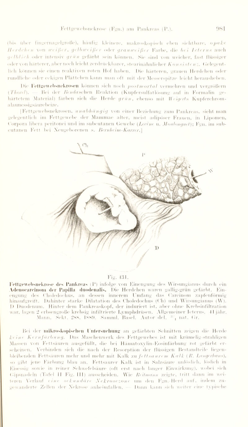 Fcttgowebsnekrosc Füii.) am Pankreas (!■.). !M t bis über I ingernagelgroße), häufig kleinere, makri iskopiseh eben sichtbare, Ojinkr II' nli hi n von in i/.h r. i/i Ihici ißci oder ij ra u irr i ßi r Farbe, die In i Irlrrnx auch i/i Ihli' li oder intensiv grün gefärbt sein können. Sie sind von weicher, last flüssiger oder von hä rt ercr. a he r noch leicht /.erd rück ha rer. st ca rinä Im lieber l\ o ii s i s I r 11 (I e lege nt • lieh können sie einen reaktiven roten llol lialien. I) i e härteren, grauen llerdehen oder rundliche oder eckigen Plättchen kann man olt mit der Messerspitze leicht herausheben. I >ie I etfgew ehsiiek rosen können sich noch jiusl ui nrht I vermehren und vergrößern (Thon I). Bei der Ihi/iln sehen Reaktion (Kupfersulfatlosung auf in Formalin ge¬ härtetem Material) färben sich die Herde grün, ebenso mit W'rlgnia Kupferchrom- alauiiessigsäureheize. | Fettgew'ebsnekrosen. u n u h/iii n ij i g von einer Beziehung /.tun Pankreas, sieht man üelcgentlieh im Fettgewebe der Mammae alter, meist adipöser Frauen, in Lipomen, Corpora liliera peritonei und im suheutanen Gewebe (Lrri'nr u. M ixilnvi/in I); Fgn. im sub- ciitanen Fett bei Neugeborenen s. Ili rnlichn- Knrrrr. \ t \\ Fig. 4:51. I VtlgewehMiekrnse tlcs Pankreas ( P) infolge von Einengung des Wirstingianus durch ein Vtienoearcinom ihr Papilla iluodenalis. Die Hertlehen waren gallig-grün gefärbt. Ein¬ engung des ('holedoehus, an dessen innerem l’mfang das Careinom zapfenförmig hinaufgreift. Dahinter starke Dilatation des Choledoclnis (Ch) und Wirstingianus (\V). I) Duodenum. Hinter dem Pankreaskojif, der induriert ist. aber ohne Krehsinfiltration war. lagen 2 erbsengroße krebsig infiltrierte Lvmphdrüsen. Allgemeiner Icterus. 4 I jälir. Mann. Sekt. 2ss. Isstt. Sa mini. P>asel. Autor del. :! , nat. (fr. Bei der inikroskopisclii‘ii Cntcrsiichung an gefärbten Schnitten zeigen die Herde l iiin Ki i iifiirl/iiiii/. Das Maschen«erk des Fettgewebes ist mit krümelig st rahligen Massen von Fettsäuren ausgefüllt, die bei Hämatoxv lin-Kosinfürbung rot gefärbt er scheinen. \'erbindcn sieh die nach der Resorption der flüssigen Bestandteile liegen¬ bleibenden Fettsäuren mehr und mehr mit Kalk zu frlhnt nn in l\nll(li‘. Lniigirlinn.*), so gibt jene Färbung blau an. Fettsaurer Kalk ist in Salzsäure unlöslich, löslich in Eisessig sowie in reiner Schwefelsäure (off erst nach langer Einwirkung), wobei sieh (dpsnadeln (’latcl II Fig. III) ausscheiden. Wie liciliixniii zeigte, tritt dann im wei¬ teren \ erlauf i i n i s i /■ // n il ii n A r kronr zohc um den Fgn. Herd aut, indem zu¬ gewanderte Zellen der Nekrose anheimfallen. Dann kann sieh weiter eine typische