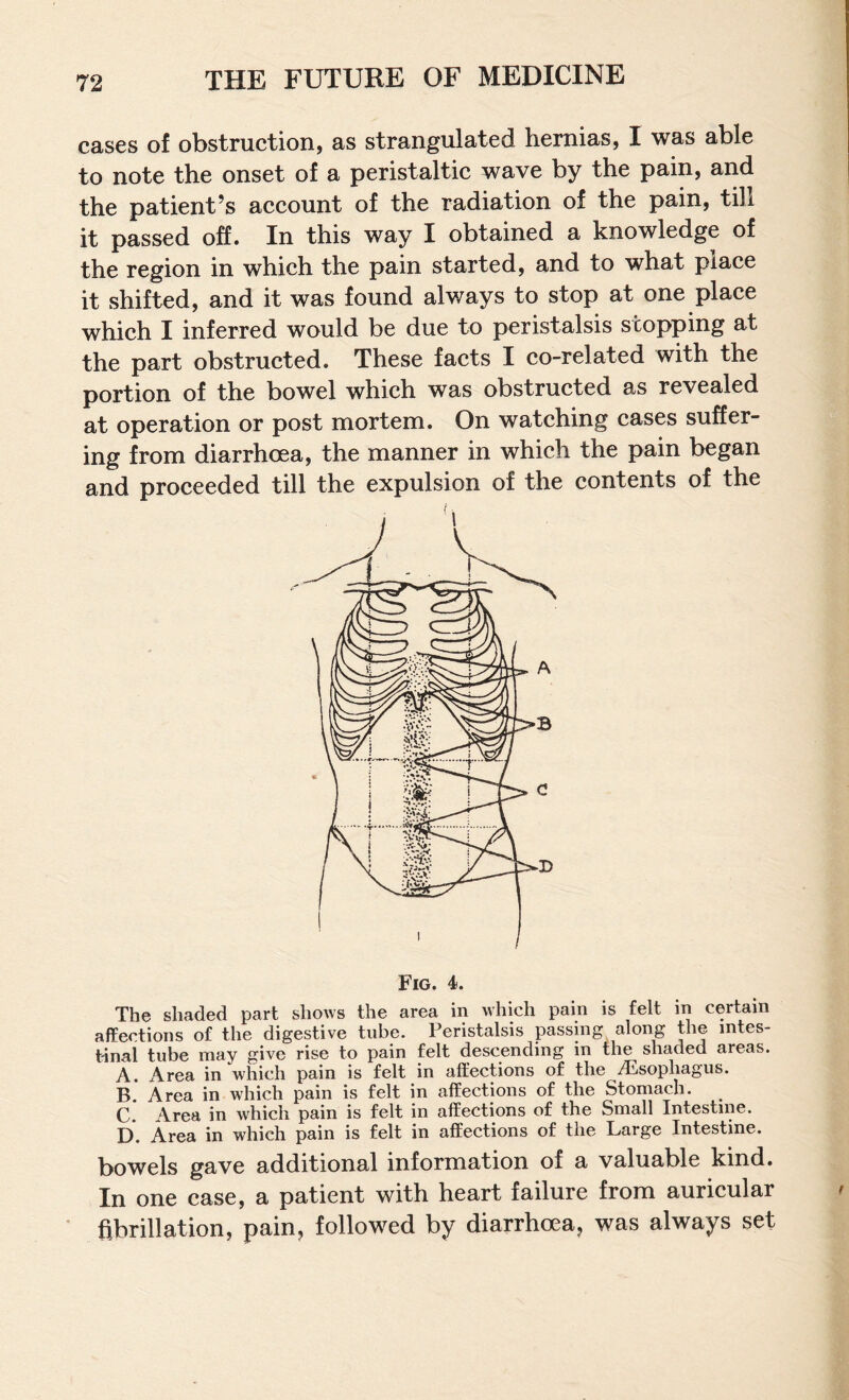 cases of obstruction, as strangulated hernias, I was able to note the onset of a peristaltic wave by the pain, and the patient’s account of the radiation of the pain, tih it passed off. In this way I obtained a knowledge of the region in which the pain started, and to what place it shifted, and it was found always to stop at one place which I inferred would be due to peristalsis stopping at the part obstructed. These facts I co-related with the portion of the bowel which was obstructed as revealed at operation or post mortem. On watching cases suffer¬ ing from diarrhoea, the manner in which the pain began and proceeded till the expulsion of the contents of the Fig. 4 The shaded part shows the area in which pain is felt in certain affections of the digestive tube. Peristalsis passing along the intes¬ tinal tube may give rise to pain felt descending in the shaded areas. A. Area in which pain is felt in affections of the Aisophagus. B. Area in which pain is felt in affections of the Stomach. C. Area in which pain is felt in affections of the Small Intestine. D. Area in which pain is felt in affections of the Large Intestine. bowels gave additional information of a valuable kind. In one case, a patient with heart failure from auricular fibrillation, pain, followed by diarrhoea, was always set