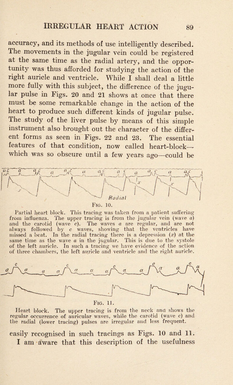 accuracy, and its methods of use intelligently described. The movements in the jugular vein could be registered at the same time as the radial artery, and the oppor¬ tunity was thus afforded for studying the action of the right auricle and ventricle. While I shall deal a little more fully with this subject, the difference of the jugu¬ lar pulse in Figs. 20 and 21 shows at once that there must be some remarkable change in the action of the heart to produce such different kinds of jugular pulse. The study of the liver pulse by means of this simple instrument also brought out the character of the differ¬ ent forms as seen in Figs. 22 and 23. The essential features of that condition, now called heart-block— which was so obscure until a few years ago—could be Partial heart block. This tracing was taken from a patient suffering from influenza. The upper tracing is from the jugular vein (wave a) and the carotid (wave c). The waves a are regular, and are not always followed by c waves, showing that the ventricles have missed a beat. In the radial tracing there is a depression (.r) at the same time as the w'ave a in the jugular. This is due to the systole of the left auricle. In such a tracing we have evidence of the action of three chambers, the left au.ricle and ventricle and the right auricle. Heart block. The upper tracing is from the neck and shows the regular occurrence of auricular waves, while the carotid (w'ave c) and the radial (low^er tracing) pulses are irregular and less frequent. easily recognised in such tracings as Figs. 10 and 11. I am aware that this description of the usefulness