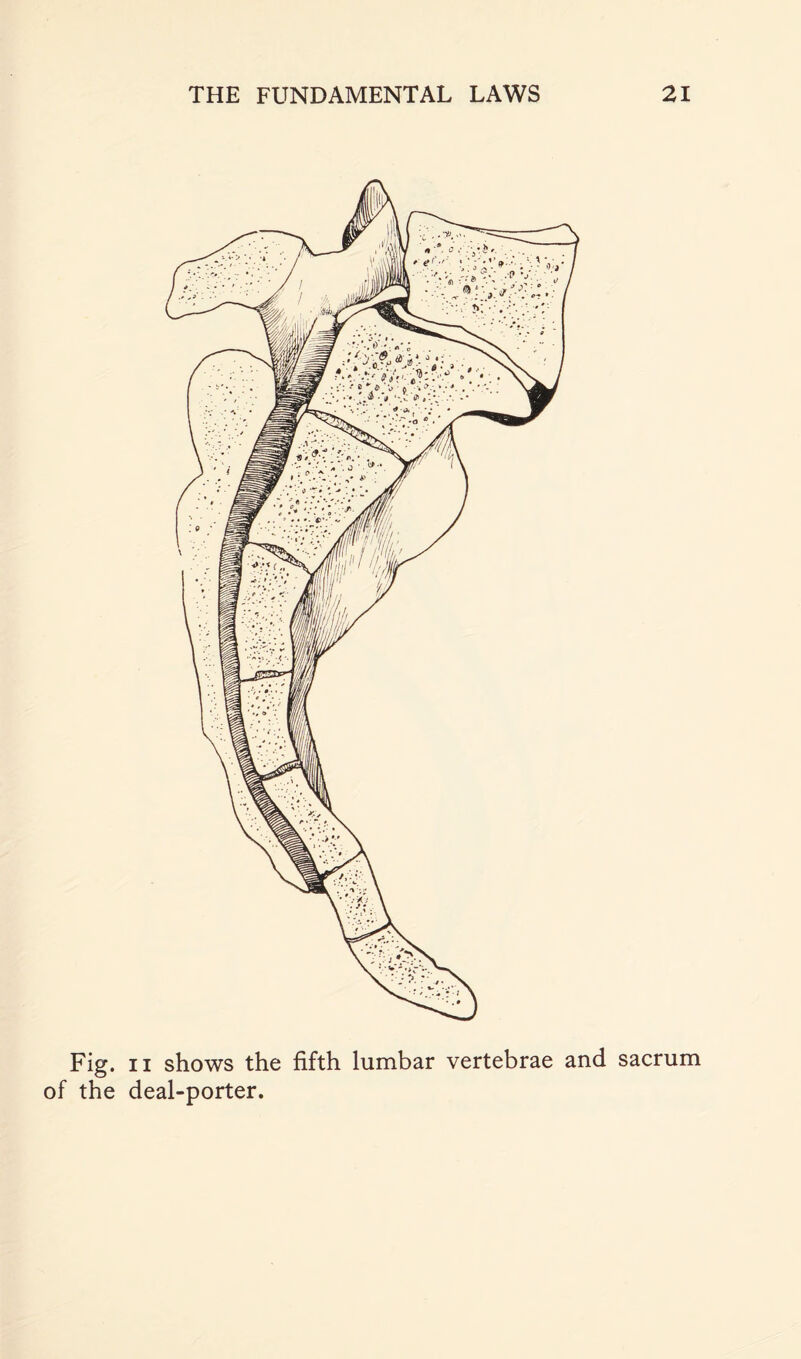 Fig. ii shows the fifth lumbar vertebrae and sacrum of the deal-porter.