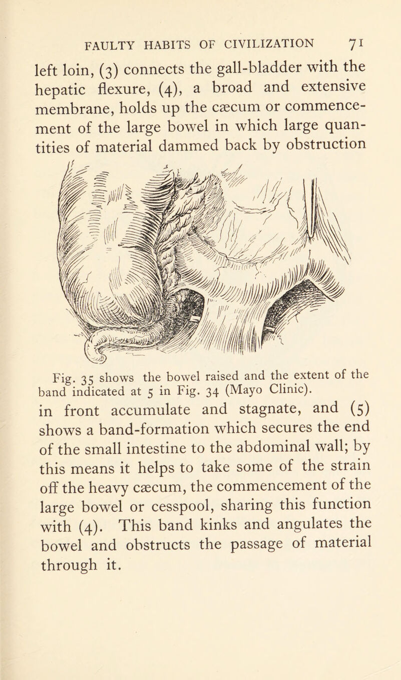 left loin, (3) connects the gall-bladder with the hepatic flexure, (4), a broad and extensive membrane, holds up the caecum or commence¬ ment of the large bowel in which large quan¬ tities of material dammed back by obstruction Fig. 35 shows the bowel raised and the extent of the band indicated at 5 in Fig. 34 (Mayo Clinic). in front accumulate and stagnate, and (5) shows a band-formation which secures the end of the small intestine to the abdominal wall; by this means it helps to take some of the strain off the heavy caecum, the commencement of the large bowel or cesspool, sharing this function with (4). This band kinks and angulates the bowel and obstructs the passage of material through it.