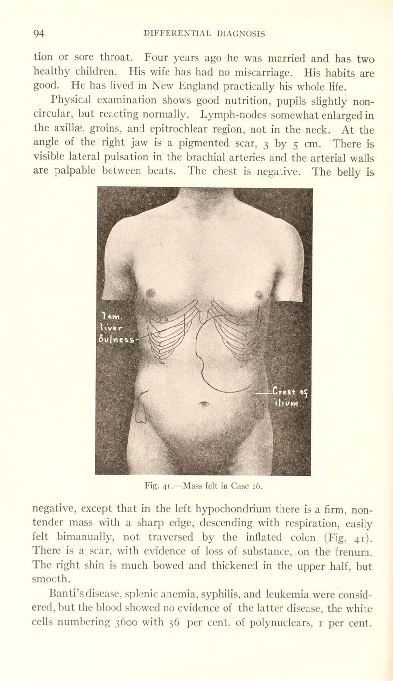 tion or sore throat. Four years ago he was married and has two healthy children. His wife has had no miscarriage. His habits are good. He has lived in New England practically his whole life. Physical examination shows good nutrition, pupils slightly non¬ circular, but reacting normally. Lymph-nodes somewhat enlarged in the axillae, groins, and epitrochlear region, not in the neck. At the angle of the right jaw is a pigmented scar, 3 by 5 cm. There is visible lateral pulsation in the brachial arteries and the arterial walls are palpable between beats. The chest is negative. The belly is Fig. 41.—Mass felt in Case 26. negative, except that in the left hypochondrium there is a firm, non¬ tender mass with a sharp edge, descending with respiration, easily felt bimanually, not traversed by the inflated colon (Fig. 41). There is a scar, with evidence of loss of substance, on the frenum. The right shin is much bowed and thickened in the upper half, but smooth. Banti’s disease, splenic anemia, syphilis, and leukemia were consid¬ ered, but the blood showed no evidence of the latter disease, the white cells numbering 3600 with 56 per cent, of polynuclears, x per cent.