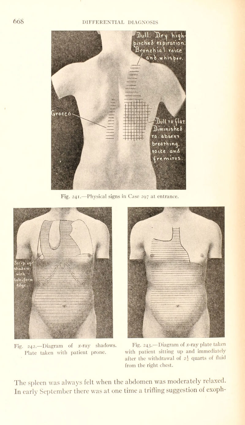 Fig. 241.—Physical signs in Case 297 at entrance. Fig. 242.—Diagram of x-ray shadows. Plate taken with patient prone. Fig. 243.—Diagram of x-ray plate taken with patient silting up and immediately after the withdrawal of 22 quarts of fluid from the right chest. The spleen was always felt when the abdomen was moderately relaxed. In early September there was at one time a trilling suggestion of exoph-
