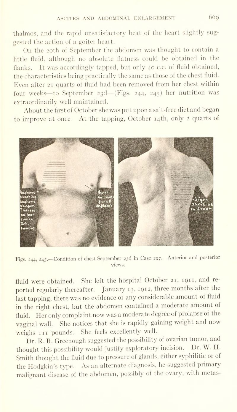 thalmos, and the rapid unsatisfactory beat ol the heart slightly sug¬ gested the action of a goiter heart. On the 20th of September the abdomen was thought to contain a little fluid, although no absolute flatness could be obtained in the flanks. It was accordingly tapped, but only 40 c.c. of fluid obtained, the characteristics being practically the same as those of the chest fluid. Even after 21 quarts of fluid had been removed from her chest within four weeks—to September 23d—(Figs. 244, 245) her nutrition was extraordinarily well maintained. About the first of October she was put upon a salt-free diet and began to improve at once At the tapping, October 14th, only 2 quarts of Figs. 244, 245.—Condition of chest September 23d in Case 297. Anterior and posterior views. fluid were obtained. She lei t the hospital October 21, 1911, and re¬ ported regularly thereafter. January 13, 1912, three months after the last tapping, there was no evidence of any considerable amount oi fluid in the right chest, but the abdomen contained a moderate amount ol fluid. Her only complaint now was a moderate degree of prolapse of the vaginal wall. She notices that she is rapidly gaining weight and now weighs in pounds. She feels excellently well. Dr. R. R. Greenough suggested the possibility of ovarian tumor, and thought this possibility would justily exploratory incision. Dr. \\ . H. Smith thought the fluid due to pressure of glands, either syphilitic or of the Hodgkin’s type. As an alternate diagnosis, he suggested primary malignant disease of the abdomen, possibly of the ovary, with metas-
