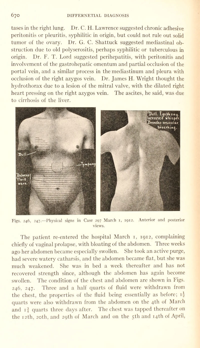 tases in the right lung. Dr. C. H. Lawrence suggested chronic adhesive peritonitis or pleuritis, syphilitic in origin, but could not rule out solid tumor of the ovary. Dr. G. C. Shattuck suggested mediastinal ob¬ struction due to old polyserositis, perhaps syphilitic or tuberculous in origin. Dr. F. T. Lord suggested perihepatitis, with peritonitis and involvement of the gastrohepatic omentum and partial occlusion of the portal vein, and a similar process in the mediastinum and pleura with occlusion of the right azygos vein. Dr. James H. Wright thought the hydrothorax due to a lesion of the mitral valve, with the dilated right heart pressing on the right azygos vein. The ascites, he said, wTas due to cirrhosis of the liver. Figs. 246, 247.—Physical signs in Case 297 March 1, 1912. Anterior and posterior views. The patient re-entered the hospital March 1, 1912, complaining chiefly of vaginal prolapse, with bloating of the abdomen. Three weeks ago her abdomen became especially swollen. She took an active purge, had severe watery catharsis, and the abdomen became flat, but she was much weakened. She was in bed a week thereafter and has not recovered strength since, although the abdomen has again become swollen. The condition of the chest and abdomen are shown in Figs. 246, 247. Three and a half quarts of fluid were withdrawn from the chest, the properties of the fluid being essentially as before; D> quarts were also withdrawn from the abdomen on the 4th of March and if quarts three days after. The chest was tapped thereafter on the 12th, 20th, and 29th of March and on the 5th and 14th of April,
