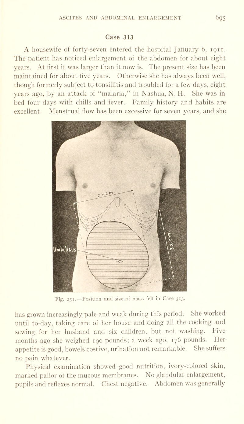 Case 313 A housewife of forty-seven entered the hospital January 6, 1911. The patient has noticed enlargement of the abdomen for about eight years. At first it was larger than it now is. The present size has been maintained for about live years. Otherwise she has always been well, though formerly subject to tonsillitis and troubled for a few days, eight years ago, by an attack of “malaria,” in Nashua, N. H. She was in bed four days with chills and fever. Family history and habits are excellent. Menstrual flow has been excessive for seven years, and she Fig. 251.—Position and size of mass felt in Case 313. has grown increasingly pale and weak during this period. She worked until to-day, taking care of her house and doing all the cooking and sewing for her husband and six children, but not washing. Five months ago she weighed iqo pounds; a week ago, 176 pounds. Her appetite is good, bowels costive, urination not remarkable. She sutlers no pain whatever. Physical examination showed good nutrition, ivory-colored skin, marked pallor of the mucous membranes. No glandular enlargement, pupils and reflexes normal. Chest negative. Abdomen was generally