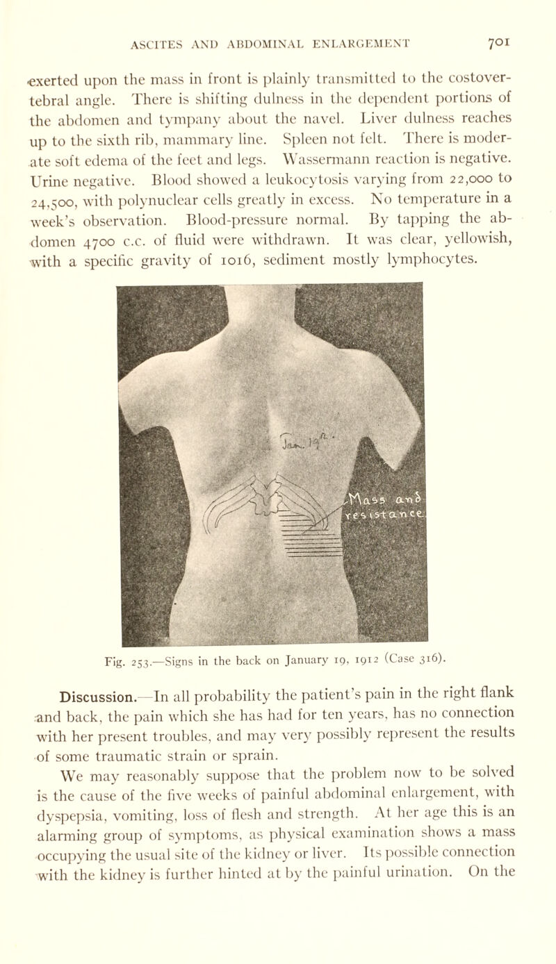 ■exerted upon the mass in front is plainly transmitted to the costover¬ tebral angle. There is shifting dulness in the dependent portions of the abdomen and tympany about the navel. Liver dulness reaches up to the sixth rib, mammary line. Spleen not felt. There is moder¬ ate soft edema of the feet and legs. Wassermann reaction is negative. Urine negative. Blood showed a leukocytosis varying from 22,000 to 24,^00, with polynuclear cells greatly in excess. No temperature in a week’s observation. Blood-pressure normal. By tapping the ab¬ domen 4700 c.c. of fluid were withdrawn. It was clear, yellowish, with a specific gravity of 1016, sediment mostly lymphocytes. Discussion. -In all probability the patient’s pain in the right flank and back, the pain which she has had for ten years, has no connection with her present troubles, and may very possibly represent the results of some traumatic strain or sprain. We may reasonably suppose that the problem now to be solved is the cause of the five weeks of painful abdominal enlargement, with dyspepsia, vomiting, loss of flesh and strength. At her age this is an alarming group of symptoms, as physical examination shows a mass occupying the usual site of the kidney or liver. Its possible connection with the kidney is further hinted at by the painful urination. On the