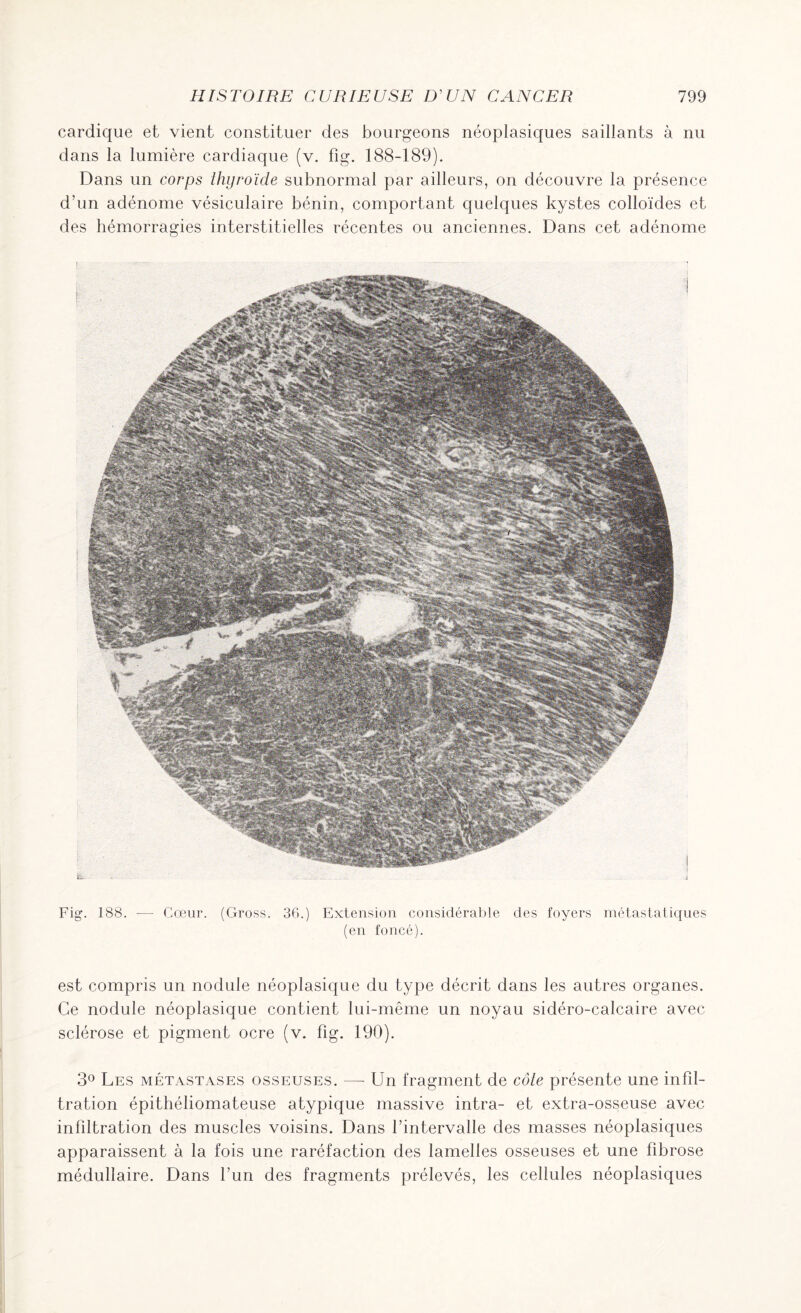 cardique et vient constituer des bourgeons néoplasiques saillants à nu dans la lumière cardiaque (v. fig. 188-189). Dans un corps thyroïde subnormal par ailleurs, on découvre la présence d’un adénome vésiculaire bénin, comportant quelques kystes colloïdes et des hémorragies interstitielles récentes ou anciennes. Dans cet adénome Fig. 188. — Cœur. (Gross. 36.) Extension considérable des foyers métastatiques (en foncé). est compris un nodule néoplasique du type décrit dans les autres organes. Ce nodule néoplasique contient lui-même un noyau sidéro-calcaire avec sclérose et pigment ocre (v. fig. 190). 3° Les métastases osseuses. —- Un fragment de côte présente une infil¬ tration épithéliomateuse atypique massive intra- et extra-osseuse avec infiltration des muscles voisins. Dans l’intervalle des masses néoplasiques apparaissent à la fois une raréfaction des lamelles osseuses et une fibrose médullaire. Dans l’un des fragments prélevés, les cellules néoplasiques