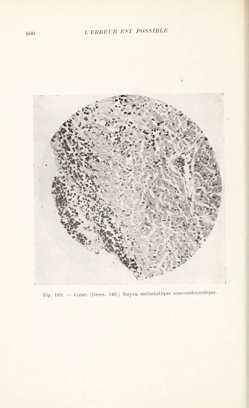 ! I Fig. 189. — Cœur. (Gross. 140.) Noyau métastatique sous-endocardique.