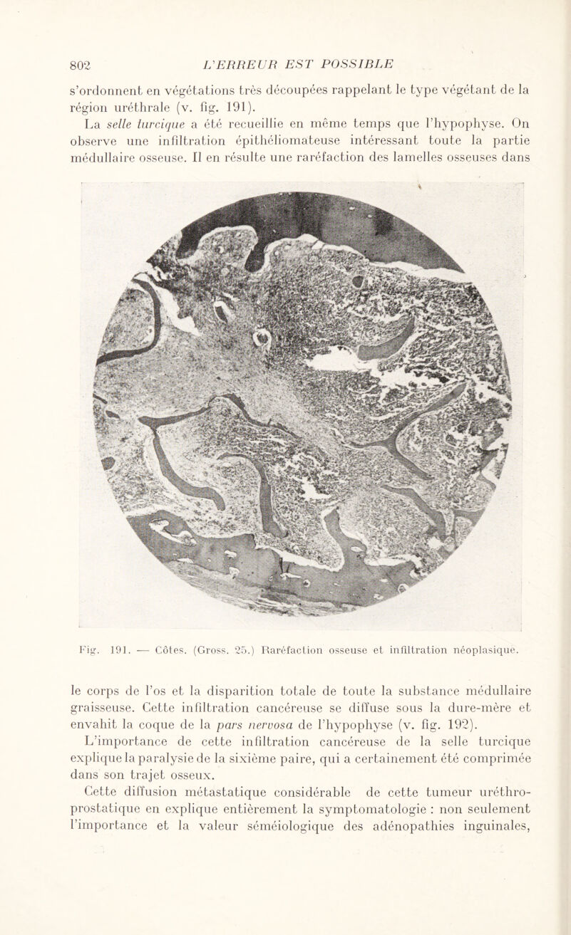 s’ordonnent en végétations très découpées rappelant le type végétant de la région uréthrale (v. fig. 191). La selle tarcique a été recueillie en même temps que l’hypophyse. On observe une infdtration épithéliomateuse intéressant toute la partie médullaire osseuse. Il en résulte une raréfaction des lamelles osseuses dans Fig. 191. — Côtes. (Gross. 25.) Raréfaction osseuse et infiltration néoplasique. le corps de l’os et la disparition totale de toute la substance médullaire graisseuse. Cette infdtration cancéreuse se diffuse sous la dure-mère et envahit la coque de la pars nervosa de l’hypophyse (v. fig. 192). L’importance de cette infdtration cancéreuse de la selle turcique explique la paralysie de la sixième paire, qui a certainement été comprimée dans son trajet osseux. Cette diffusion métastatique considérable de cette tumeur uréthro- prostatique en explique entièrement la symptomatologie : non seulement l’importance et la valeur séméiologique des adénopathies inguinales,