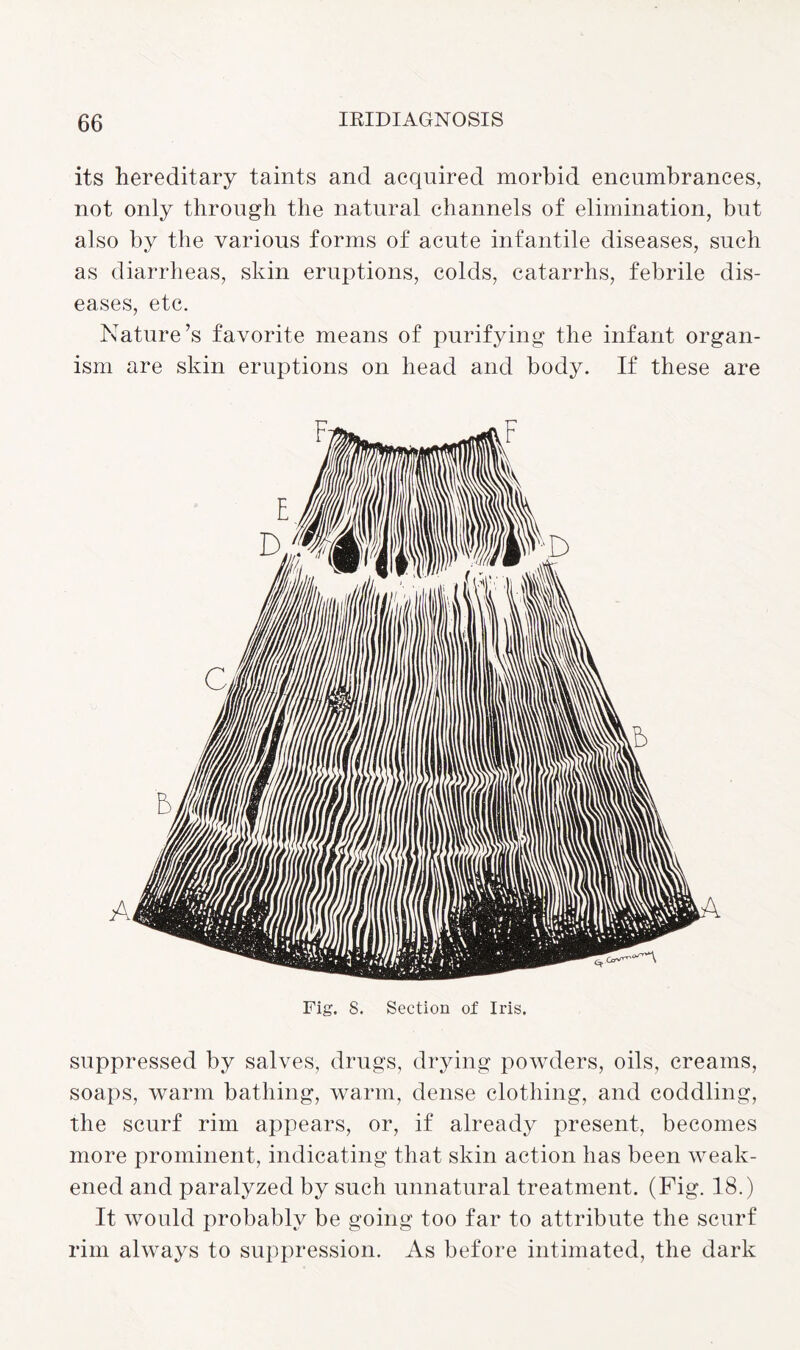 its hereditary taints and acquired morbid encumbrances, not only through the natural channels of elimination, but also by the various forms of acute infantile diseases, such as diarrheas, skin eruptions, colds, catarrhs, febrile dis¬ eases, etc. Nature’s favorite means of purifying the infant organ¬ ism are skin eruptions on head and body. If these are Fig. S. Section of Iris. suppressed by salves, drugs, drying powders, oils, creams, soaps, warm bathing, warm, dense clothing, and coddling, the scurf rim appears, or, if already present, becomes more prominent, indicating that skin action has been weak¬ ened and paralyzed by such unnatural treatment. (Fig. 18.) It would probably be going too far to attribute the scurf rim always to suppression. As before intimated, the dark