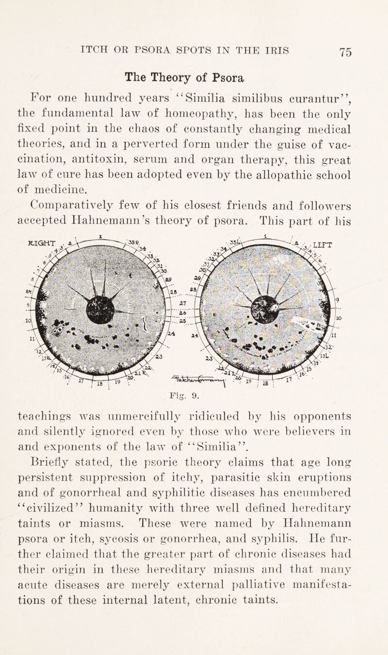 The Theory of Psora For one hundred years “Similia similibus curantur”, the fundamental law of homeopathy, has been the only fixed point in the chaos of constantly changing medical theories, and in a perverted form under the guise of vac¬ cination, antitoxin, serum and organ therapy, this great law of cure has been adopted even by the allopathic school of medicine. Comparatively few of his closest friends and followers accepted Hahnemann’s theory of psora. This part of his Fig. 9. teachings was unmercifully ridiculed by his opponents and silently ignored even by those who were believers in and exponents of the law of “Similia”. Briefly stated, the psoric theory claims that age long persistent suppression of itchy, parasitic skin eruptions and of gonorrheal and syphilitic diseases has encumbered “civilized” humanity with three well defined hereditary taints or miasms. These were named by Hahnemann psora or itch, sycosis or gonorrhea, and syphilis. He fur¬ ther claimed that the greater part of chronic diseases had their origin in these hereditary miasms and that many acute diseases are merely external palliative manifesta¬ tions of these internal latent, chronic taints.