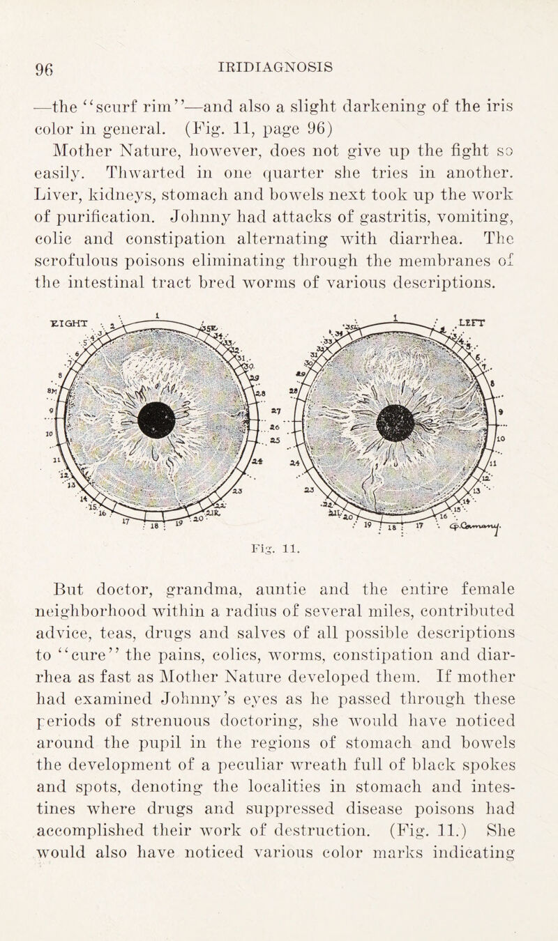 —the “scurf rim”—and also a slight darkening of the iris color in general. (Fig. 11, page 96) Mother Nature, however, does not give up the fight so easily. Thwarted in one quarter she tries in another. Liver, kidneys, stomach and bowels next took up the work of purification. Johnny had attacks of gastritis, vomiting, colic and constipation alternating with diarrhea. The scrofulous poisons eliminating through the membranes of the intestinal tract bred worms of various descriptions. Fig. 11. But doctor, grandma, auntie and the entire female neighborhood within a radius of several miles, contributed advice, teas, drugs and salves of all possible descriptions to “cure” the pains, colics, worms, constipation and diar¬ rhea as fast as Mother Nature developed them. If mother had examined Johnny’s eyes as he passed through these periods of strenuous doctoring, she would have noticed around the pupil in the regions of stomach and bowels the development of a peculiar wreath full of black spokes and spots, denoting the localities in stomach and intes¬ tines where drugs and suppressed disease poisons had accomplished their work of destruction. (Fig. 11.) She would also have noticed various color marks indicating