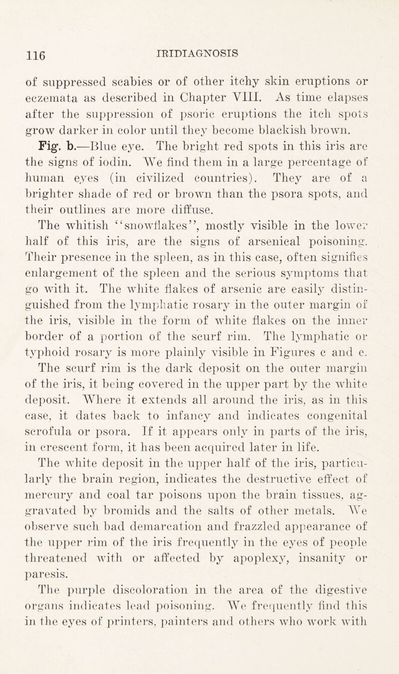 of suppressed scabies or of other itchy skin eruptions or eczemata as described in Chapter VIII. As time elapses after the suppression of psoric eruptions the itch spots grow darker in color until they become blackish brown. Fig. b .—Blue eye. The bright red spots in this iris are the signs of iodin. We find them in a large percentage of human eyes (in civilized countries). They are of a brighter shade of red or brown than the psora spots, and their outlines are more diffuse. The whitish “snowflakes”, mostly visible in the lower half of this iris, are the signs of arsenical poisoning. Their presence in the spleen, as in this case, often signifies enlargement of the spleen and the serious symptoms that go with it. The white flakes of arsenic are easily distin¬ guished from the lymphatic rosary in the outer margin of the iris, visible in the form of white flakes on the inner border of a portion of the scurf rim. The lymphatic or typhoid rosary is more plainly visible in Figures c and e. The scurf rim is the dark deposit on the outer margin of the iris, it being covered in the upper part by the white deposit. Where it extends all around the iris, as in this case, it dates back to infancy and indicates congenital scrofula or psora. If it appears only in parts of the iris, in crescent form, it has been acquired later in life. The white deposit in the upper half of the iris, particu¬ larly the brain region, indicates the destructive effect of mercury and coal tar poisons upon the brain tissues, ag¬ gravated by bromids and the salts of other metals. We observe such bad demarcation and frazzled appearance of the upper rim of the iris frequently in the eyes of people threatened with or affected by apoplexy, insanity or paresis. The purple discoloration in the area of the digestive organs indicates lead poisoning. We frequently find this in the eyes of printers, painters and others who work with
