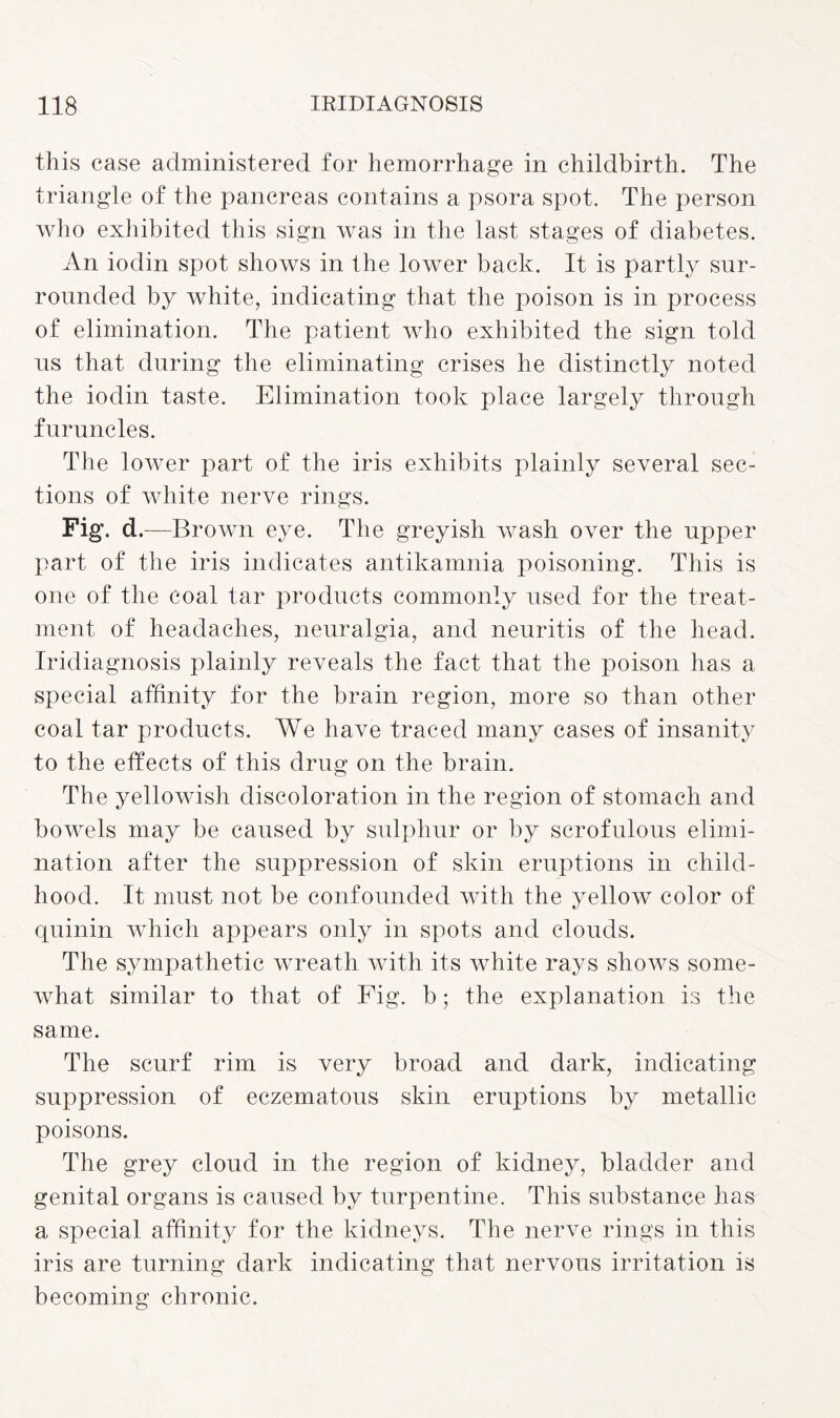 this case administered for hemorrhage in childbirth. The triangle of the pancreas contains a psora spot. The person who exhibited this sign was in the last stages of diabetes. An iodin spot shows in the lower back. It is partly sur¬ rounded by white, indicating that the poison is in process of elimination. The patient who exhibited the sign told us that during the eliminating crises he distinctly noted the iodin taste. Elimination took place largely through furuncles. The lower part of the iris exhibits plainly several sec¬ tions of white nerve rings. Fig. d .—Brown eye. The greyish wash over the upper part of the iris indicates antikamnia poisoning. This is one of the coal tar products commonly used for the treat¬ ment of headaches, neuralgia, and neuritis of the head. Iridiagnosis plainly reveals the fact that the poison has a special affinity for the brain region, more so than other coal tar products. We have traced many cases of insanity to the effects of this drug on the brain. The yellowish discoloration in the region of stomach and bowels may be caused by sulphur or by scrofulous elimi¬ nation after the suppression of skin eruptions in child¬ hood. It must not be confounded with the yellow color of quinin which appears only in spots and clouds. The sympathetic wreath with its white rays shows some¬ what similar to that of Fig. b; the explanation is the same. The scurf rim is very broad and dark, indicating suppression of eczematous skin eruptions by metallic poisons. The grey cloud in the region of kidney, bladder and genital organs is caused by turpentine. This substance has a special affinity for the kidneys. The nerve rings in this iris are turning dark indicating that nervous irritation is becoming chronic.