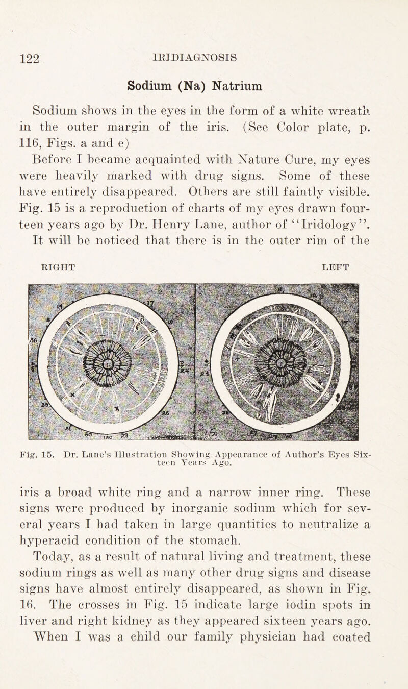 Sodium (Na) Natrium Sodium shows in the eyes in the form of a white wreath, in the outer margin of the iris. (See Color plate, p. 116, Figs, a and e) Before I became acquainted with Nature Cure, my eyes were heavily marked with drug signs. Some of these have entirely disappeared. Others are still faintly visible. Fig. 15 is a reproduction of charts of my eyes drawn four¬ teen years ago by Dr. Henry Lane, author of “Iridology”. It will be noticed that there is in the outer rim of the RIGHT LEFT Fig. 15. Dr. Lane’s Illustration Showing Appearance of Author’s Eyes Six¬ teen Years Ago. iris a broad white ring and a narrow inner ring. These signs were produced by inorganic sodium which for sev¬ eral years I had taken in large quantities to neutralize a hyperacid condition of the stomach. Today, as a result of natural living and treatment, these sodium rings as well as many other drug signs and disease signs have almost entirely disappeared, as shown in Fig. 16. The crosses in Fig. 15 indicate large iodin spots in liver and right kidney as they appeared sixteen years ago. When I was a child our family physician had coated