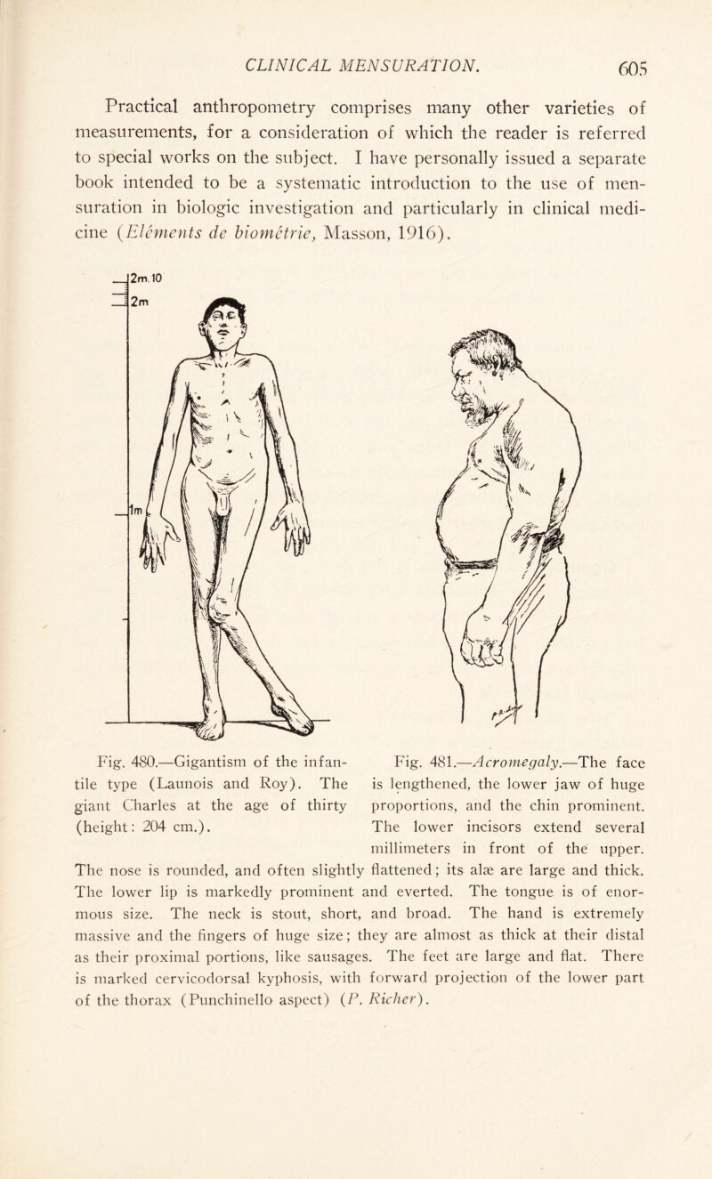 Practical anthropometry comprises many other varieties of measurements, for a consideration of which the reader is referred to special works on the subject. I have personally issued a separate book intended to be a systematic introduction to the use of men¬ suration in biologic investigation and particularly in clinical medi¬ cine (Eléments de biométrie, Masson, 1916). Fig. 480.—Gigantism of the infan¬ tile type (Launois and Roy). The giant Charles at the age of thirty (height: 204 cm.). Fig. 481.—Acromegaly.—The face is lengthened, the lower jaw of huge proportions, and the chin prominent. The lower incisors extend several millimeters in front of the upper. The nose is rounded, and often slightly flattened ; its alæ are large and thick. The lower lip is markedly prominent and everted. The tongue is of enor¬ mous size. The neck is stout, short, and broad. The hand is extremely massive and the fingers of huge size ; they are almost as thick at their distal as their proximal portions, like sausages. The feet are large and flat. There is marked cervicodorsal kyphosis, with forward projection of the lower part of the thorax (Punchinello aspect) (P. Richer).