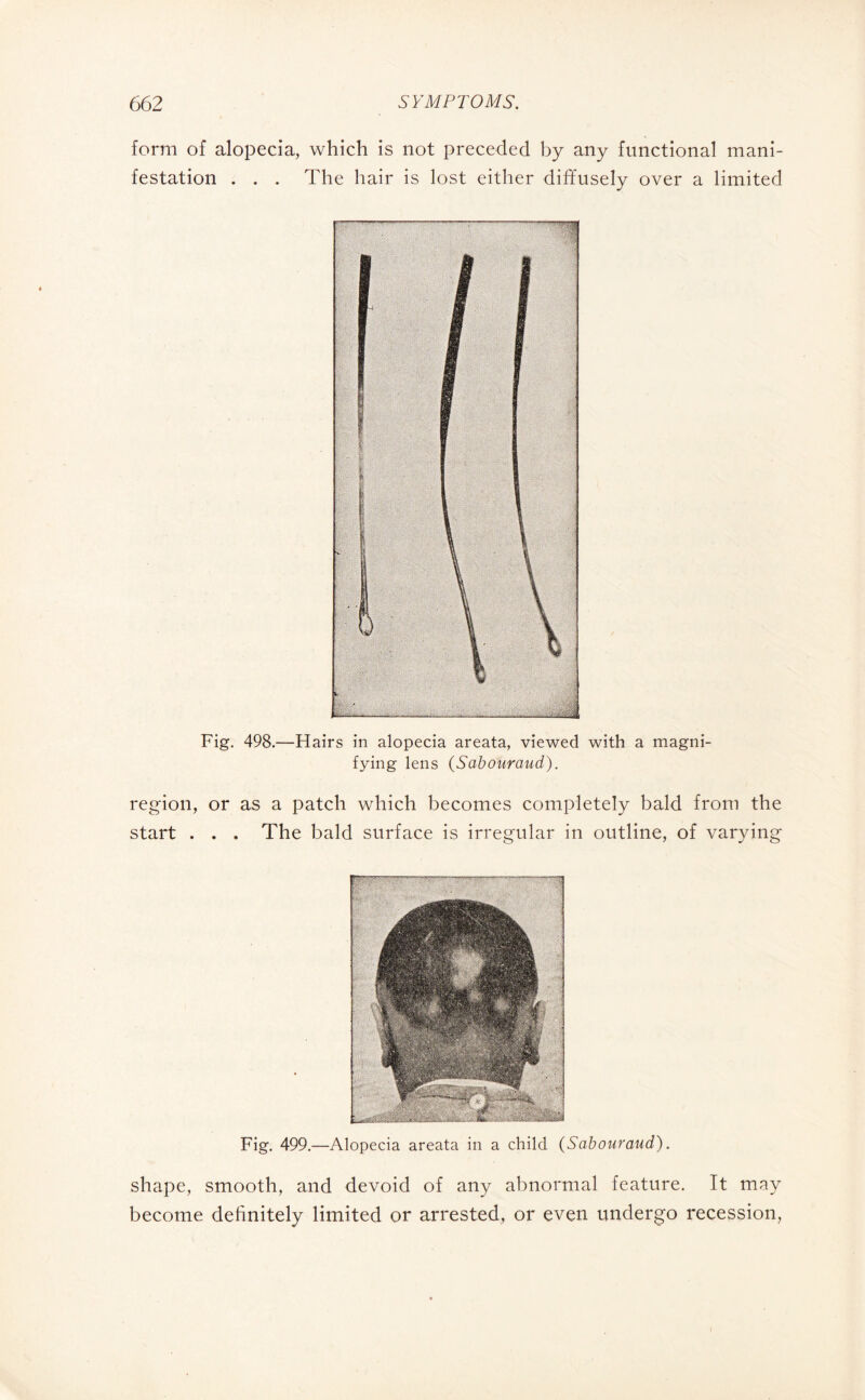 form of alopecia, which is not preceded by any functional mani¬ festation . . . The hair is lost either diffusely over a limited Fig. 498.—Hairs in alopecia areata, viewed with a magni¬ fying lens (Sabouraud). region, or as a patch which becomes completely bald from the start . . . The bald surface is irregular in outline, of varying Fig. 499.—Alopecia areata in a child (Sabouraud). shape, smooth, and devoid of any abnormal feature. It may become definitely limited or arrested, or even undergo recession,