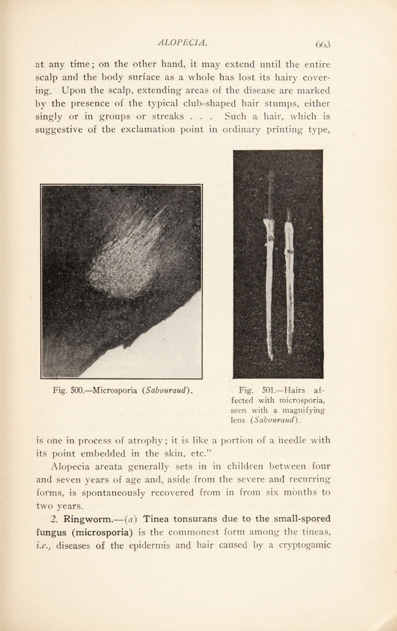 at any time ; on the other hand, it may extend until the entire scalp and the body surface as a whole has lost its hairy cover¬ ing. Upon the scalp, extending areas of the disease are marked Iby the presence of the typical club-shaped hair stumps, either singly or in groups or streaks . . . Such a hair, which is suggestive of the exclamation point in ordinary printing type, Fig. 501.—Hairs af¬ fected with microsporia, seen with a magnifying lens (Sabouraud). is one in process of atrophy; it is like a portion of a needle with its point embedded in the skin, etc.” Alopecia areata generally sets in in children between four and seven years of age and, aside from the severe and recurring forms, is spontaneously recovered from in from six months to two years. 2. Ringworm.— (a) Tinea tonsurans due to the small-spored fungus (microsporia) is the commonest form among the tineas, i.e., diseases of the epidermis and hair caused by a cryptogamie Fig. 500.—Microsporia (Sabouraud).