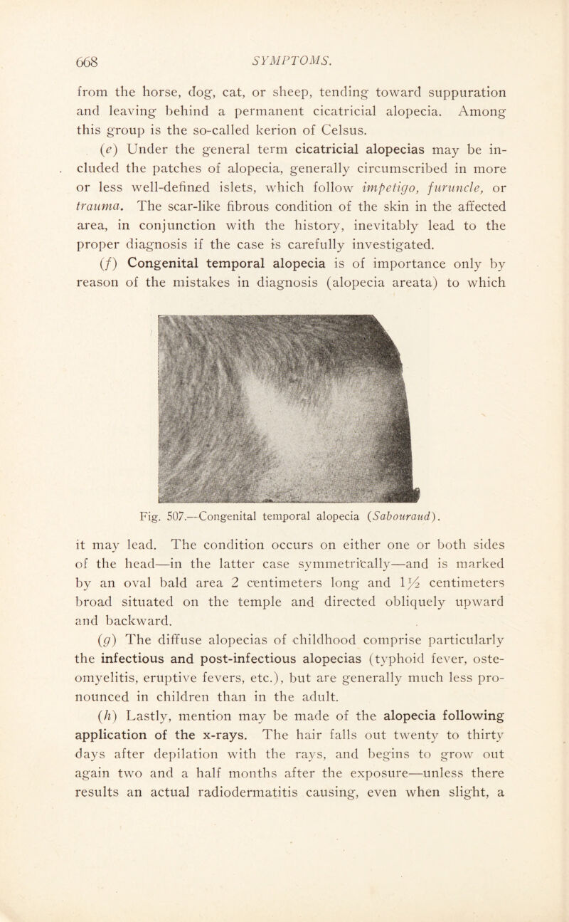 from the horse, dog, cat, or sheep, tending toward suppuration and leaving behind a permanent cicatricial alopecia. Among this group is the so-called kerion of Celsus. (e) Under the general term cicatricial alopecias may be in¬ cluded the patches of alopecia, generally circumscribed in more or less well-defined islets, which follow impetigo, furuncle, or trauma. The scar-like fibrous condition of the skin in the affected area, in conjunction with the history, inevitably lead to the proper diagnosis if the case is carefully investigated. (/) Congenital temporal alopecia is of importance only by reason of the mistakes in diagnosis (alopecia areata) to which Fig. 507.—Congenital temporal alopecia (Sabouraud). it may lead. The condition occurs on either one or both sides of the head—in the latter case symmetrically—and is marked by an oval bald area 2 centimeters long and ljT centimeters broad situated on the temple and directed obliquely upward and backward. (g) The diffuse alopecias of childhood comprise particularly the infectious and post-infectious alopecias (typhoid fever, oste¬ omyelitis, eruptive fevers, etc.), but are generally much less pro¬ nounced in children than in the adult. (h) Lastly, mention may be made of the alopecia following application of the x-rays. The hair falls out twenty to thirty days after dépilation with the rays, and begins to grow out again two and a half months after the exposure—unless there results an actual radiodermatitis causing, even when slight, a