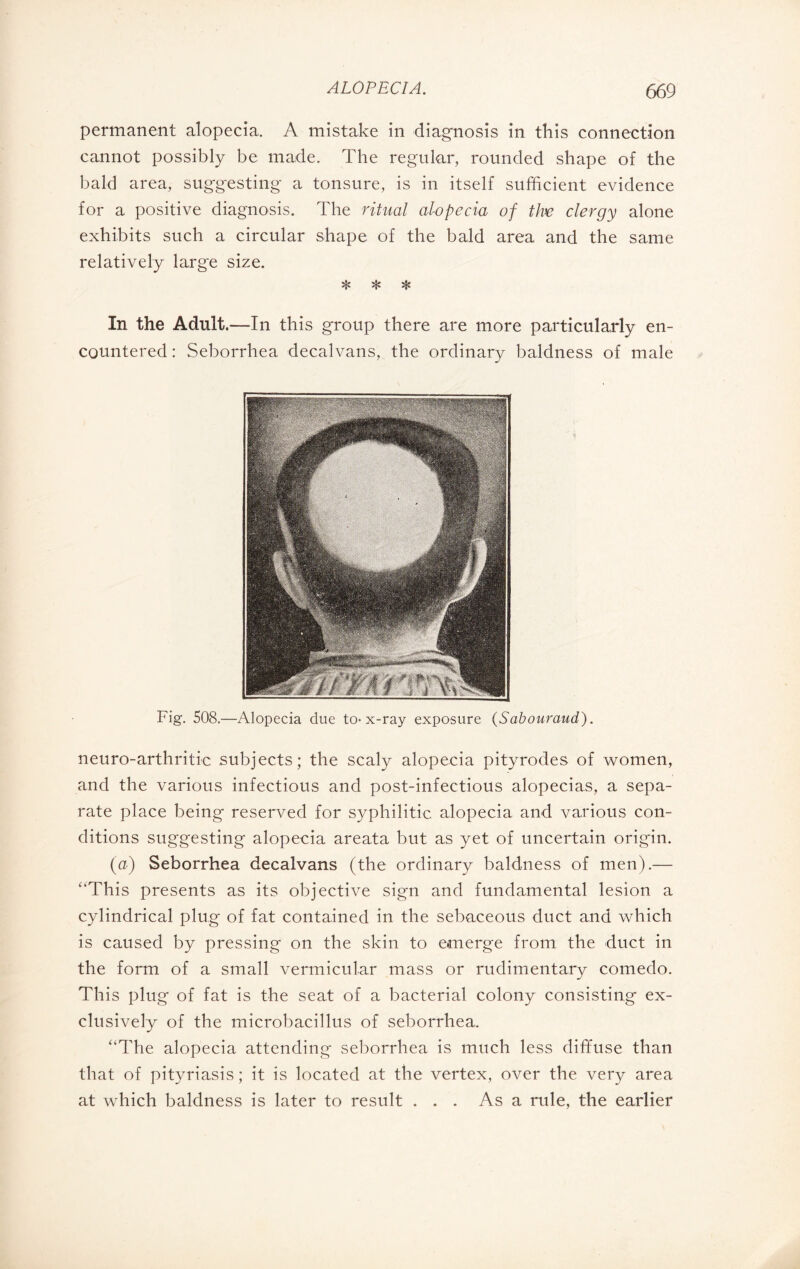 permanent alopecia. A mistake in diagnosis in this connection cannot possibly be made. The regular, rounded shape of the bald area, suggesting a tonsure, is in itself sufficient evidence for a positive diagnosis. The ritual alopecia of the clergy alone exhibits such a circular shape of the bald area and the same relatively large size. * * * In the Adult.—In this group there are more particularly en¬ countered : Seborrhea decalvans, the ordinary baldness of male Fig. 508.—Alopecia due to-x-ray exposure (Sabouraud). neuro-arthritic subjects; the scaly alopecia pityrodes of women, and the various infectious and post-infectious alopecias, a sepa¬ rate place being* reserved for syphilitic alopecia and various con¬ ditions suggesting alopecia areata but as yet of uncertain origin. (a) Seborrhea decalvans (the ordinary baldness of men).— '‘This presents as its objective sign and fundamental lesion a cylindrical plug of fat contained in the sebaceous duct and which is caused by pressing on the skin to emerge from the duct in the form of a small vermicular mass or rudimentary comedo. This plug of fat is the seat of a bacterial colony consisting ex¬ clusively of the microbacillus of seborrhea. “The alopecia attending seborrhea is much less diffuse than that of pityriasis ; it is located at the vertex, over the very area at which baldness is later to result . . . As a rule, the earlier