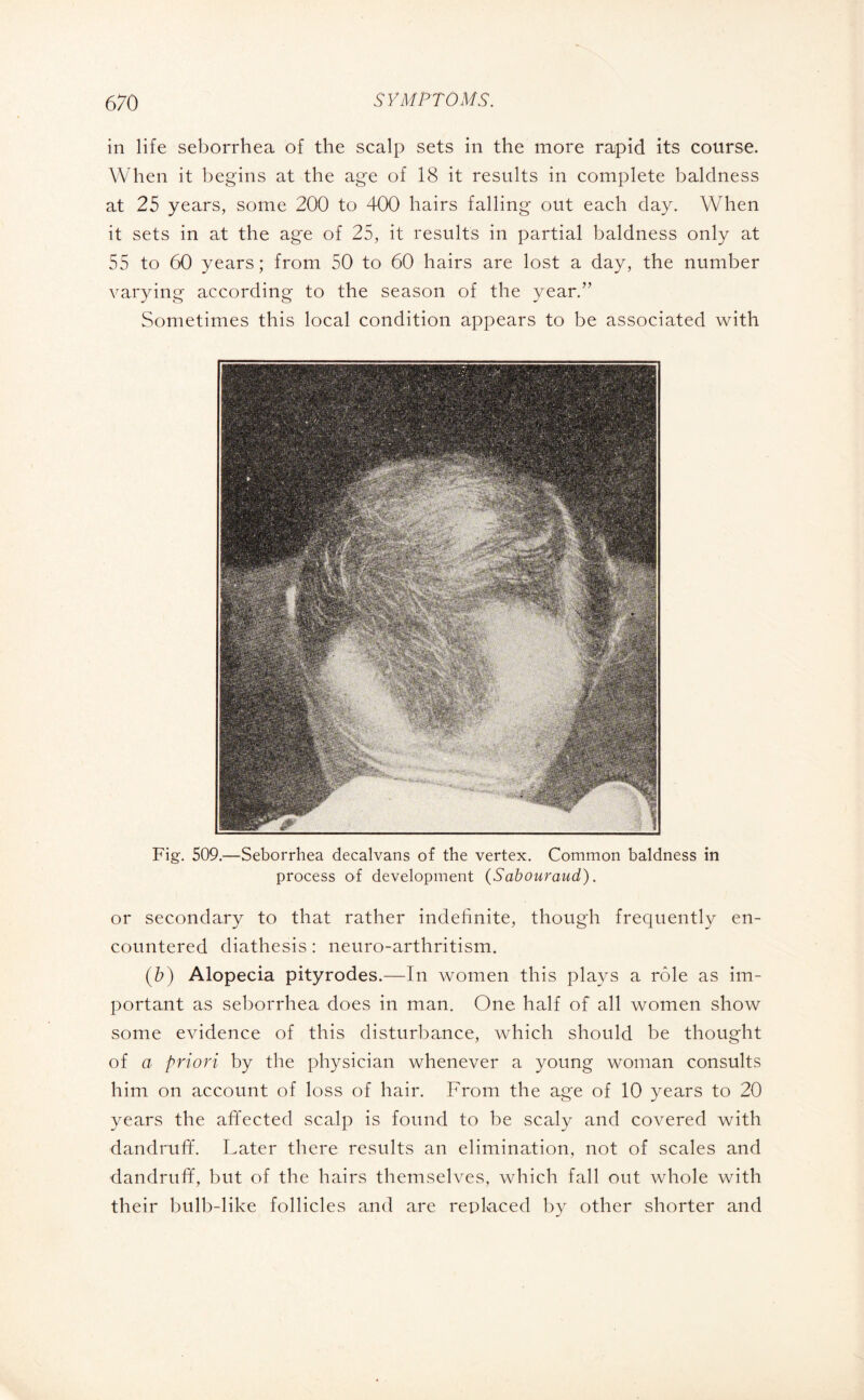 in life seborrhea of the scalp sets in the more rapid its course. When it begins at the age of 18 it results in complete baldness at 25 years, some 200 to 400 hairs falling out each day. When it sets in at the age of 25, it results in partial baldness only at 55 to 60 years ; from 50 to 60 hairs are lost a day, the number varying according to the season of the year.” Sometimes this local condition appears to be associated with Fig. 509.—Seborrhea decalvans of the vertex. Common baldness in process of development (Sabouraud). or secondary to that rather indefinite, though frequently en¬ countered diathesis : neuro-arthritism. (b) Alopecia pityrodes.—In women this plays a rôle as im¬ portant as seborrhea does in man. One half of all women show some evidence of this disturbance, which should be thought of a priori by the physician whenever a young woman consults him on account of loss of hair. From the age of 10 years to 20 years the affected scalp is found to be scaly and covered with dandruff. Later there results an elimination, not of scales and dandruff, but of the hairs themselves, which fall out whole with their bulb-like follicles and are replaced by other shorter and