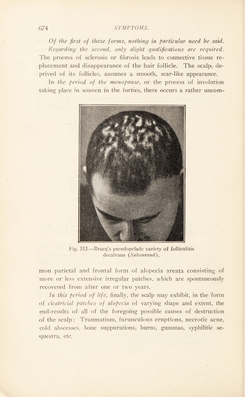 Of the first of these forms, nothing in particular need he said. Regarding the second, only slight qualifications are required. The process of sclerosis or fibrosis leads to connective tissue re¬ placement and disappearance of the hair follicle. The scalp, de¬ prived of its follicles, assumes a smooth, scar-like appearance. In the period of the menopause, or the process of involution taking place in women in the forties, there occurs a rather uncom- Fig. 513.—Brocq’s pseudopelade variety of folliculitis decalvans (Sabouraud). mon parietal and frontal form of alopecia areata consisting of more or less extensive irregular patches, which are spontaneously recovered from after one or two years. In this period of life, finally, the scalp may exhibit, in the form of cicatricial patches of alopecia of varying shape and extent, the end-results of all of the foregoing possible causes of destruction of the scalp: Traumatism, furunculous eruptions, necrotic acne, cold abscesses, bone suppurations, burns, gummas, syphilitic sé¬ questra, etc.