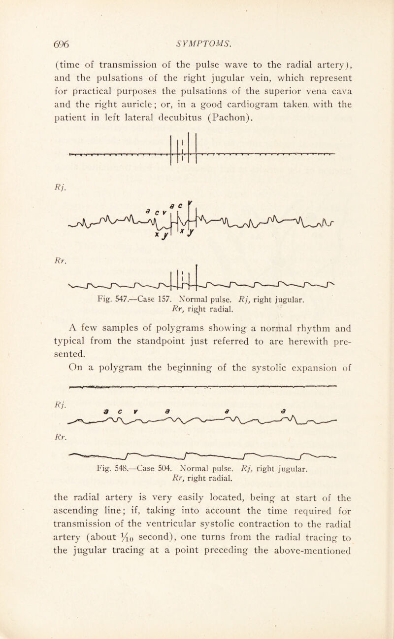 (time of transmission of the pulse wave to the radial artery), and the pulsations of the right jugular vein, which represent for practical purposes the pulsations of the superior vena cava and the right auricle ; or, in a good cardiogram taken, with the patient in left lateral decubitus (Pachon). t Trnr ■f r irnr t r ■> i » i Rj. 3 C V a c xy * y Rr. Fig. 547.—Case 157. Normal pulse. Rj, right jugular. Rr, right radial. A few samples of polygrams showing a normal rhythm and typical from the standpoint just referred to are herewith pre¬ sented. On a polygram the beginning of the systolic expansion of Rj. a c v a a a Fig. 548.—Case 504. Normal pulse. Rj, right jugular. Rr, right radial. the radial artery is very easily located, being at start of the ascending line; if, taking into account the time required for transmission of the ventricular systolic contraction to the radial artery (about %0 second), one turns from the radial tracing to the jugular tracing at a point preceding the above-mentioned