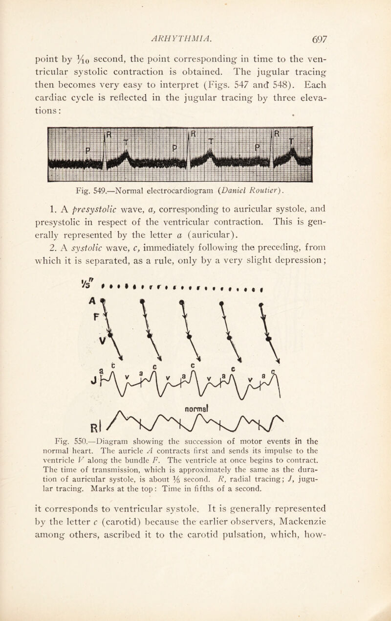 point by VlO second, the point corresponding' in time to the ven¬ tricular systolic contraction is obtained. The jugular tracing then becomes very easy to interpret (Figs. 547 and* 548). Each cardiac cycle is reflected in the jugular tracing by three eleva¬ tions : Fig. 549.—Normal electrocardiogram (Daniel Routier). 1. A presystolic wave, a, corresponding to auricular systole, and presystolic in respect of the ventricular contraction. This is gen¬ erally represented by the letter a (auricular). 2. A systolic wave, c, immediately following the preceding, from which it is separated, as a rule, only by a very slight depression ; « « i Fig. 550.—Diagram showing the succession of motor events in the normal heart. The auricle A contracts first and sends its impulse to the ventricle V along the bundle F. The ventricle at once begins to contract. The time of transmission, which is approximately the same as the dura¬ tion of auricular systole, is about % second. R, radial tracing; J, jugu¬ lar tracing. Marks at the top : Time in fifths of a second. it corresponds to ventricular systole. It is generally represented by the letter c (carotid) because the earlier observers, Mackenzie among others, ascribed it to the carotid pulsation, which, how-