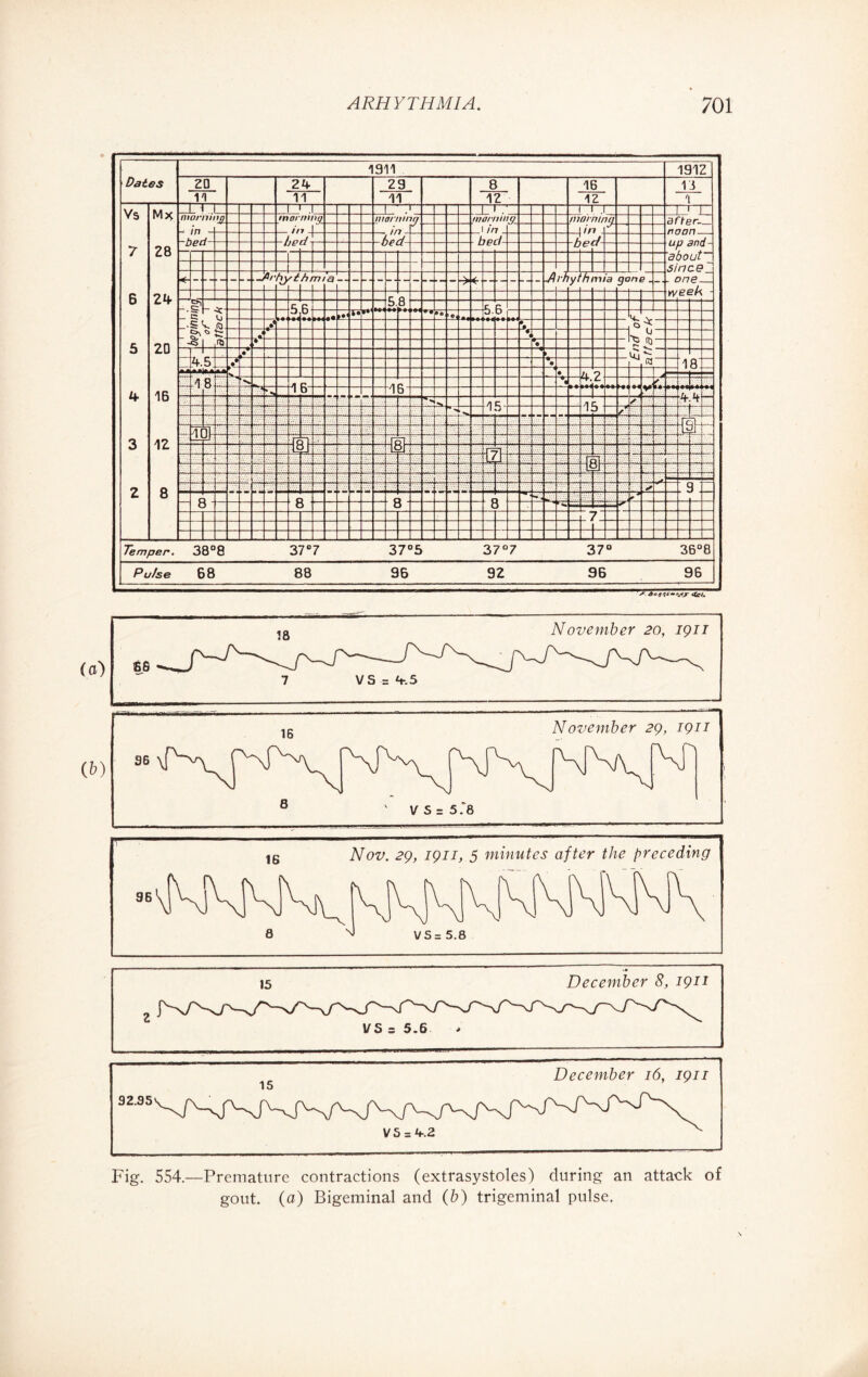 1 911 191Z Paies 20 24 29 8 16 13 n 11 11 12 12 1 Vs M* l i r 1 T~ ' i T 77/<7/* mnn morning mormng morning mamma after- in in i in . I in ■4 i _ Ur,r! L_rS up and - 7 28 i about i sine.9 -l 6 24 r: & KKctrrs - g» 5 R a 5.6 c: A). • *4 (• O •*- < r-> 0 5 20 '6 • Lt ► ùj <1 — 4 b / • —i — S3 18 ir N -+~ « 4.2 ft L 1 ■ 4 16 *. 4 b A B LV ** 1 C. . 15 <* *r; “ 9 > / ■ Jot 1 ii 3 12 ip o / r 2 8 . 9 - « * o o o o 7 Temper. 38°8 37°7 37°5 37°7 37° _36°8 Pulse 68 88 96_92_96 96 69WW «Ce/. Fig. 554.—Premature contractions (extrasystoles) during an attack of gout, (a) Bigeminal and (b) trigeminal pulse.