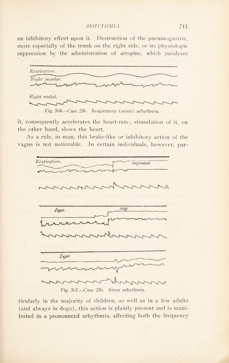 an inhibitory effect upon it. Destruction of the pneumogastric, more especially of the trunk on the right side, or its physiologic suppression by the administration of atropine, which paralyzes III | I I l '. I I r » I I I I I ■ I T l T ■ I I Vl-I » | I 1 I I I I ■! | II | I l-rr I ■ ■ ... III. Respiration. Right jugular. Right radial. Fig. 564.—Case 236. Respiratory (sinus) arhythmia. it, consequently accelerates the heart-rate ; stimulation of it, on the other hand, slows the heart. As a rule, in man, this brake-like or inhibitory action of the vagus is not noticeable. In certain individuals, however, par- ** '« r1» tn-ri'v rrm » » * » > r »r* * trrt rvTf** tv* » * r 11 m n mv r-.ryn ■» r rrrf-nfrf3 Fig. 565.—'Case 236. Sinus arhythmia. ticularly in the majority of children, as well as in a few adults (and always in dogs), this action is plainly present and is mani¬ fested in a pronounced arhythmia, affecting both the frequency