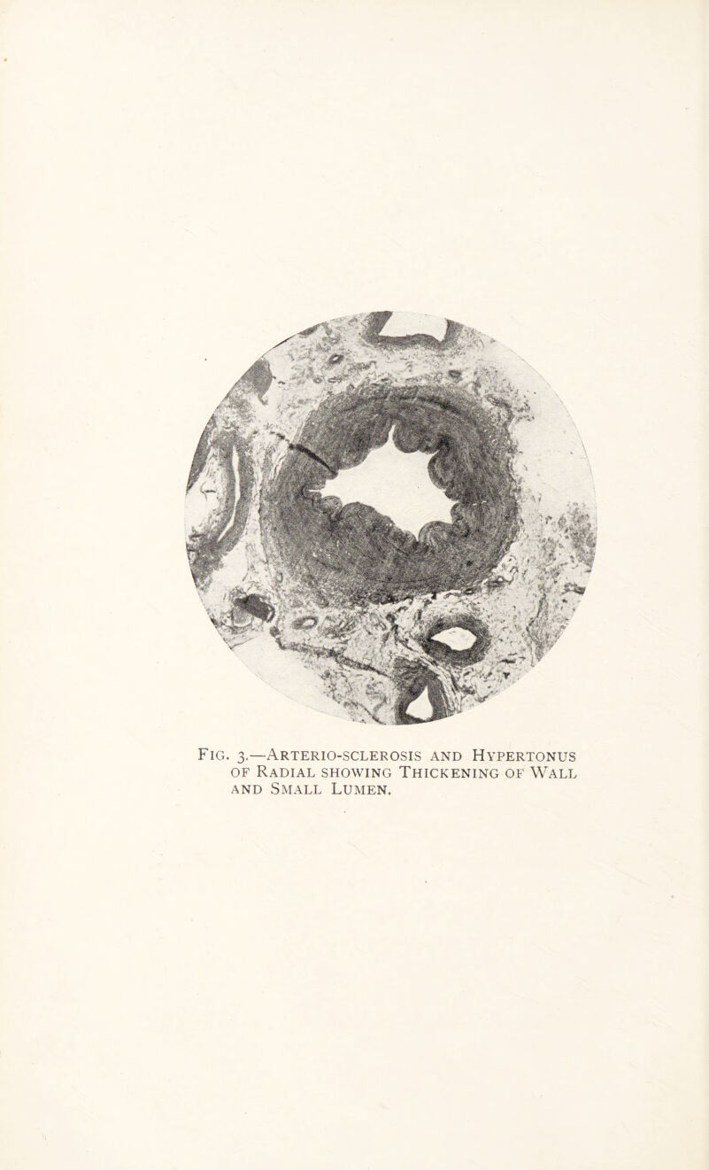 Fig. 3.—Arteriosclerosis and Hypertonus of Radial showing Thickening of Wall and Small Lumen.
