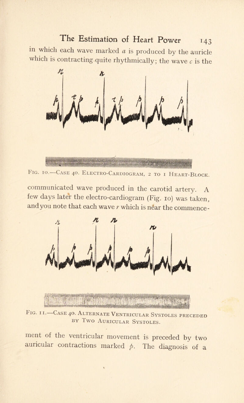 in which each wave marked ci is produced by the auricle which is contracting.quite rhythmically; the wave c is the Fig. 10.—Case 40. Electro-Cardiogram, 2 to i Heart-Block. communicated wave produced in the carotid artery. A few days later the electro-cardiogram (Fig. 10) was taken, and you note that each wave r which is nfiar the commence- K n> Hf Fig. 11. Case 40. Alternate Ventricular Systoles preceded by two Auricular Systoles. ment of the ventricular movement is preceded by two auricular contractions marked p. The diagnosis of a