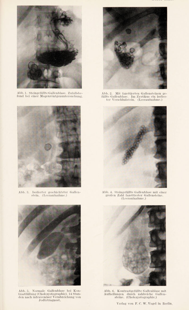 Abb.l. Steingefüllte Gallenblase. Zufallsbe- Abb. 2. Mit fazettierten Gallensteinen ge¬ filmt bei einer Magenröntgenuntersuchung. füllte Gallenblase. Im Zystikus ein isolier¬ ter Verschlußstein. (Leeraufnahme.) Abb. 3. Isolierter geschichteter Gallen¬ stein. (Leeraufnahme.) Abb. 4. Steingefüllte Gallenblase mit einer großen Zahl fazettierter Gallensteine. (Leeraufnahme.) Abb. 5. Normale Gallenblase bei Kon- Abb. 6. Kontrastgefüllte Gallenblase mit trastfüllung (Cholezystograjihie). 14 Stun- Aufhellungen durch zahlreiche Gallen¬ den nach intravenöser Verabreichung von steine. (Cholezystographie.) Jodtetragnost. Verlag von F.C.W. Vogel in Berlin.